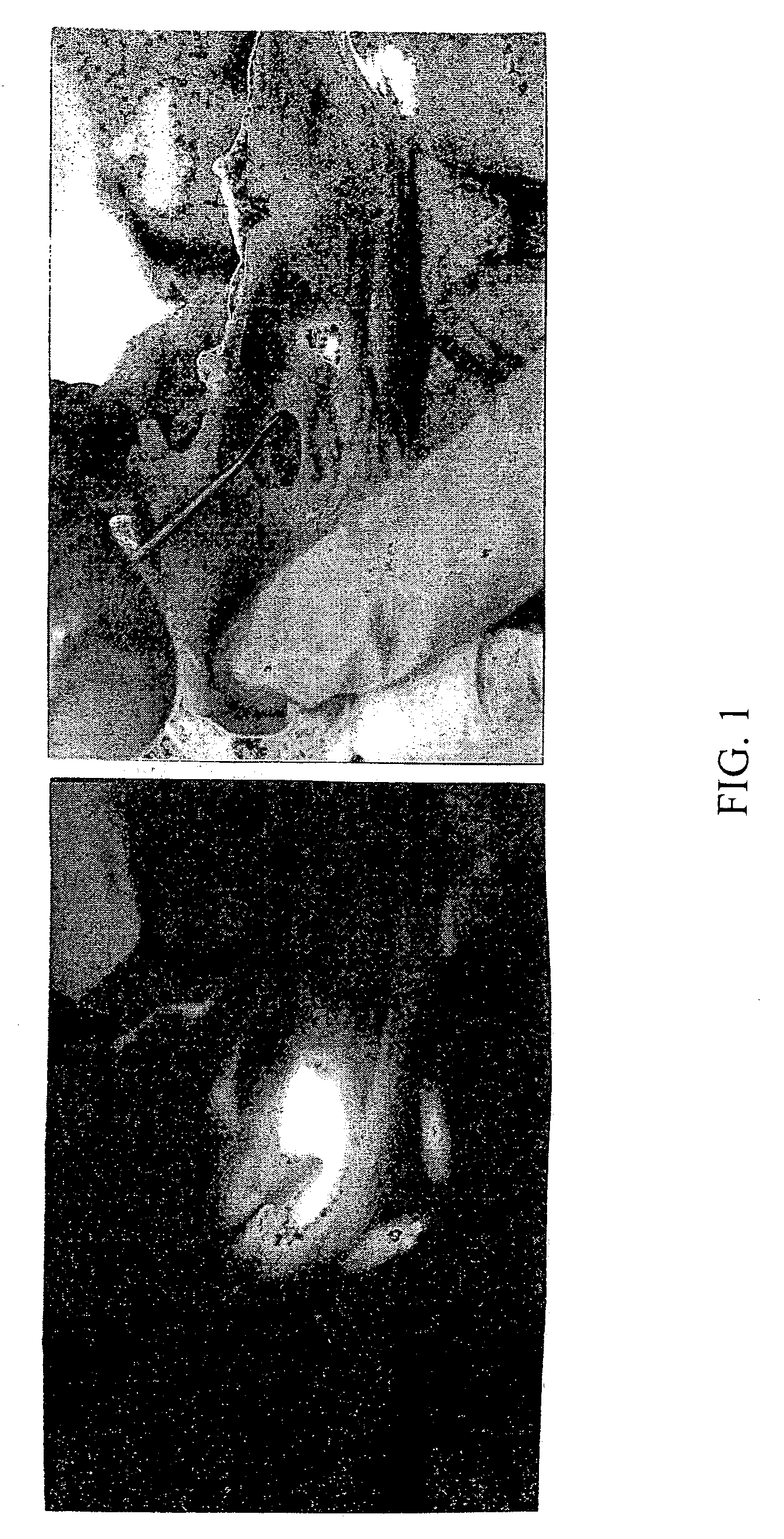 Method and apparatus for detecting and achieving closure of patent foramen ovale