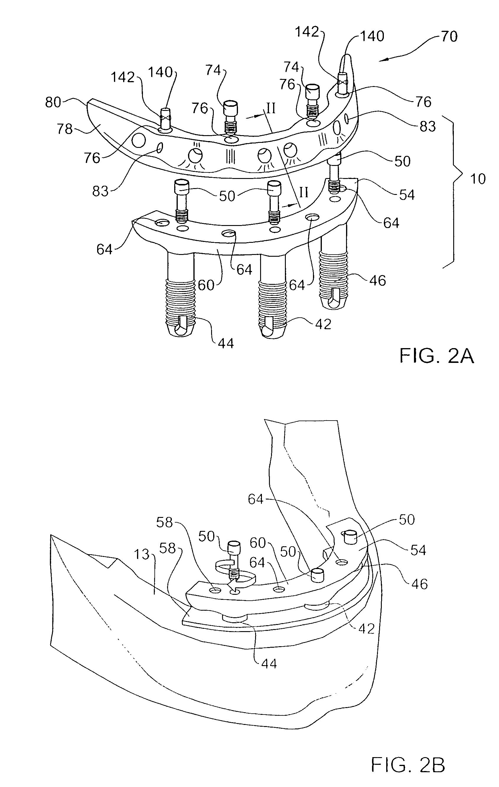 Method and system for fixing removable dentures