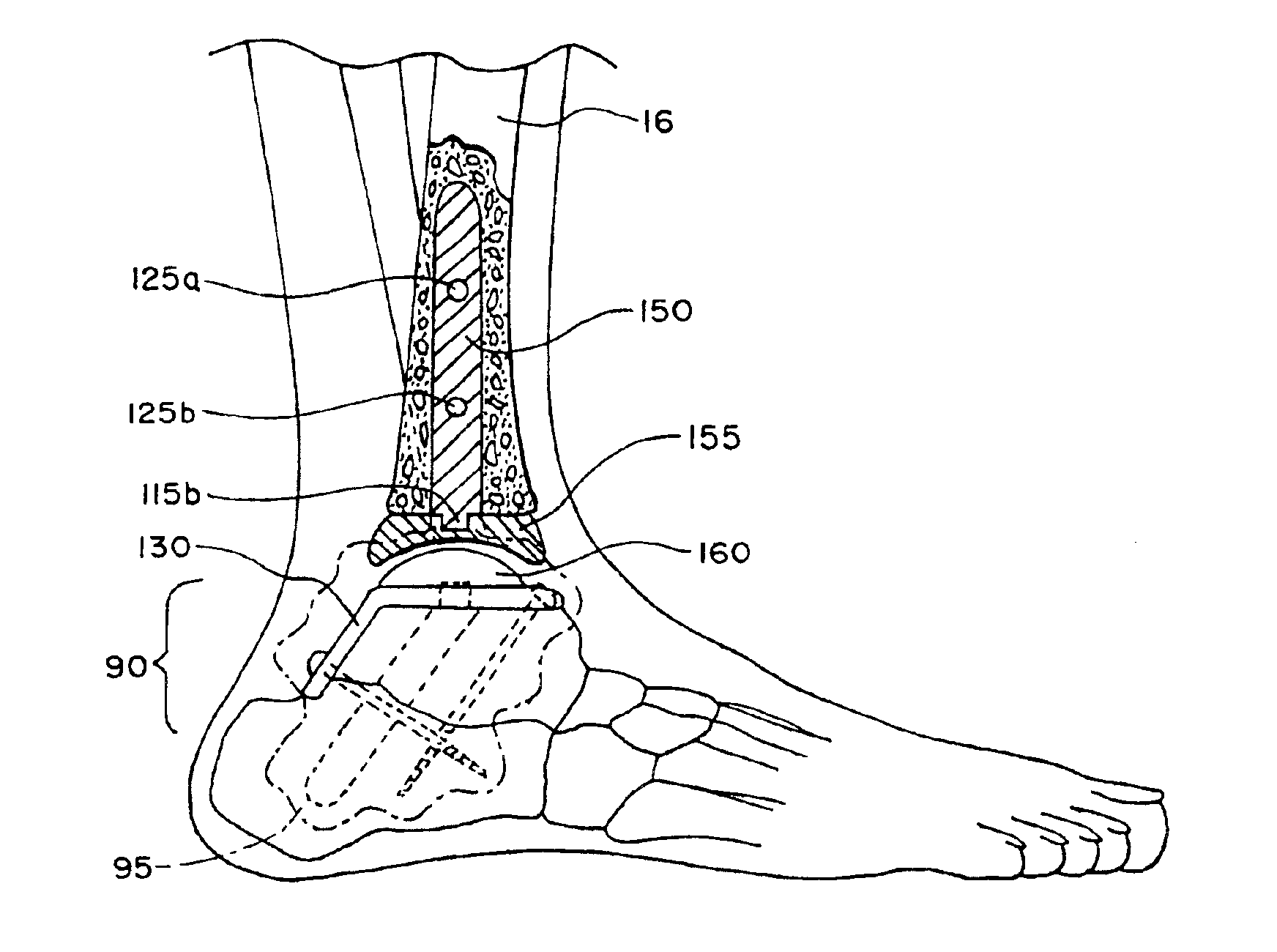 Intramedullary guidance systems and methods for installing ankle replacement prostheses