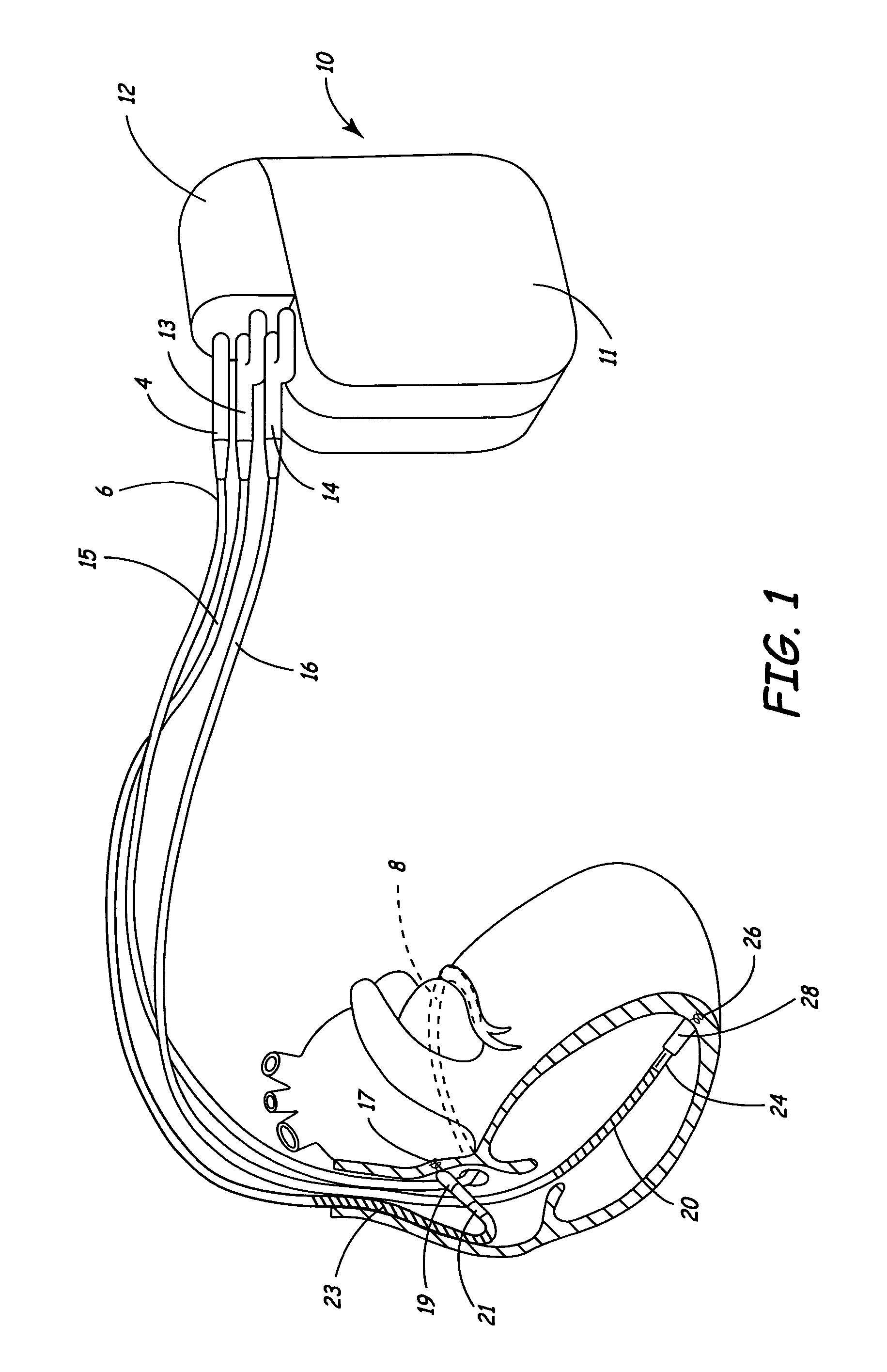 Dual chamber method and apparatus for diagnosis and treatment of arrhythmias