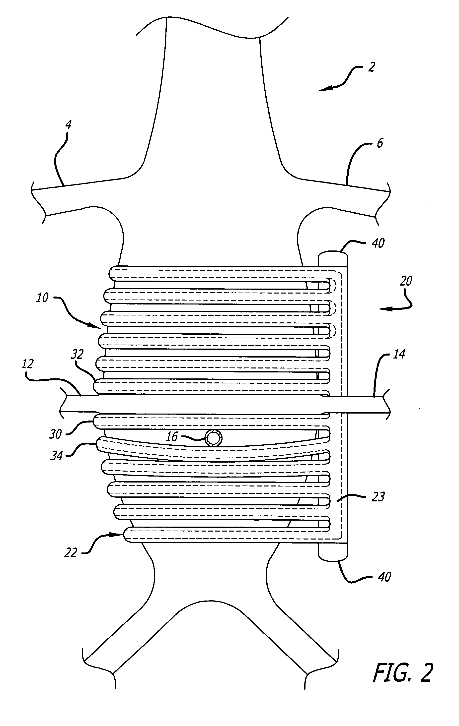 Aneurysm treatment system and method