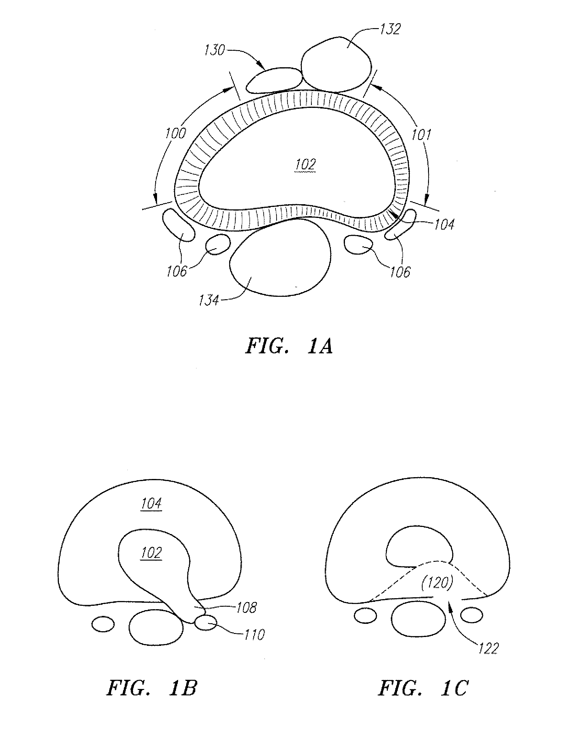 Devices used to treat disc herniation and attachment mechanisms therefore