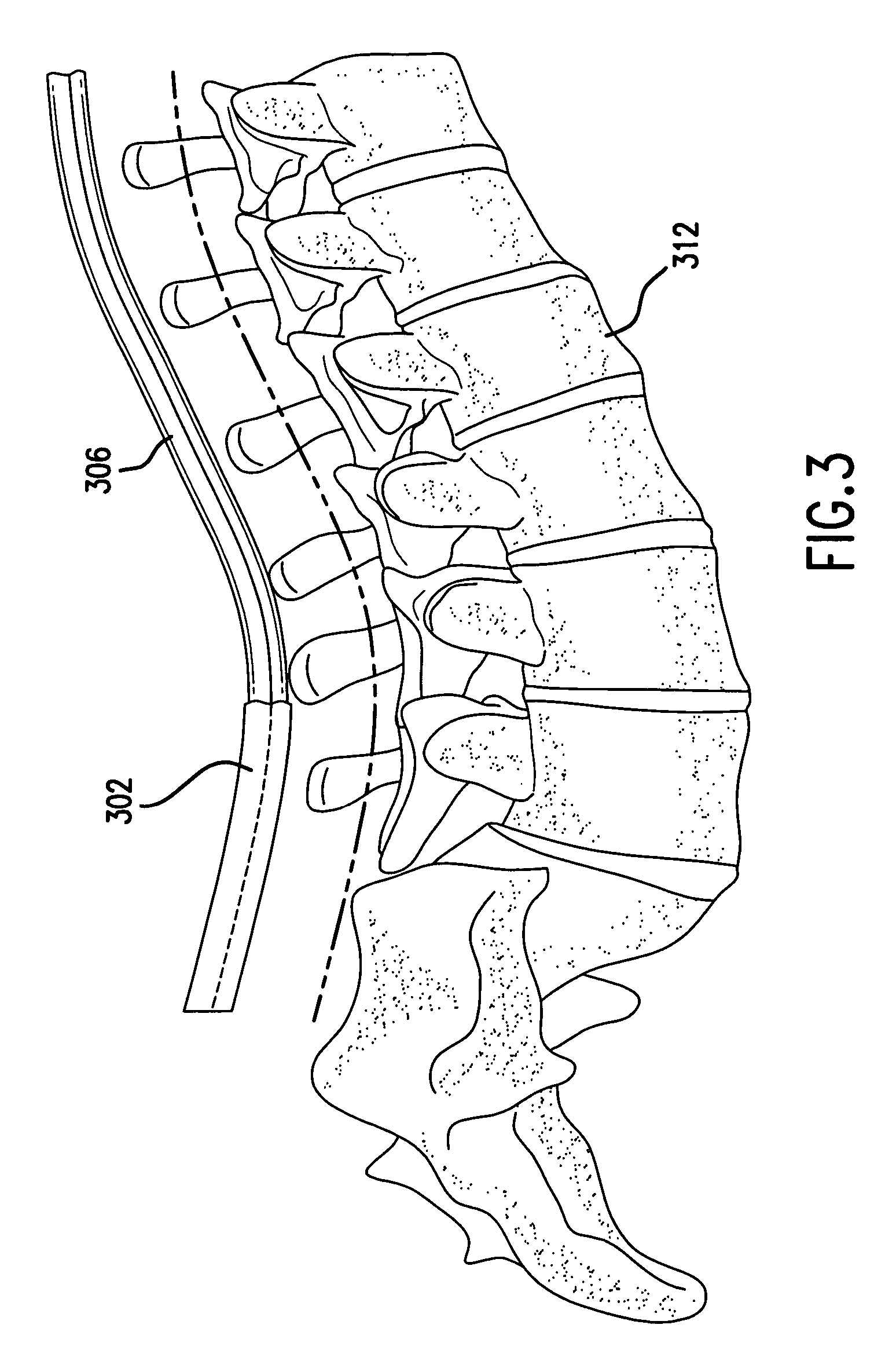 Spinal curvature correction device