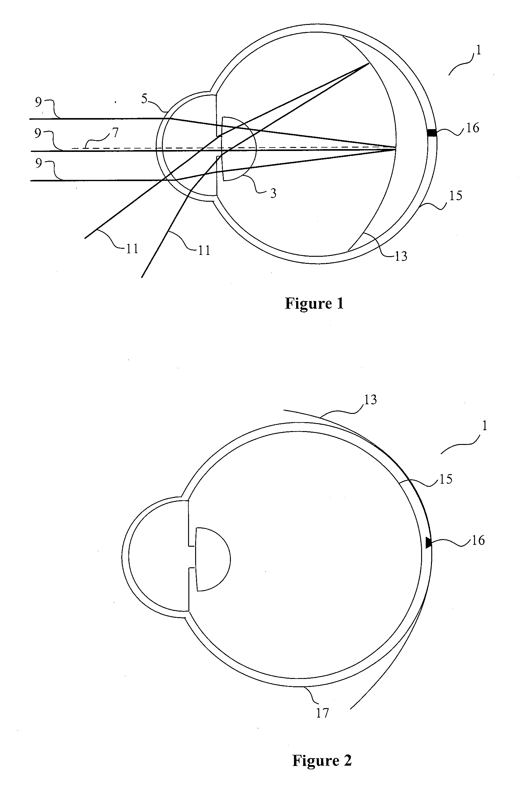 System and method to treat and prevent loss of visual acuity