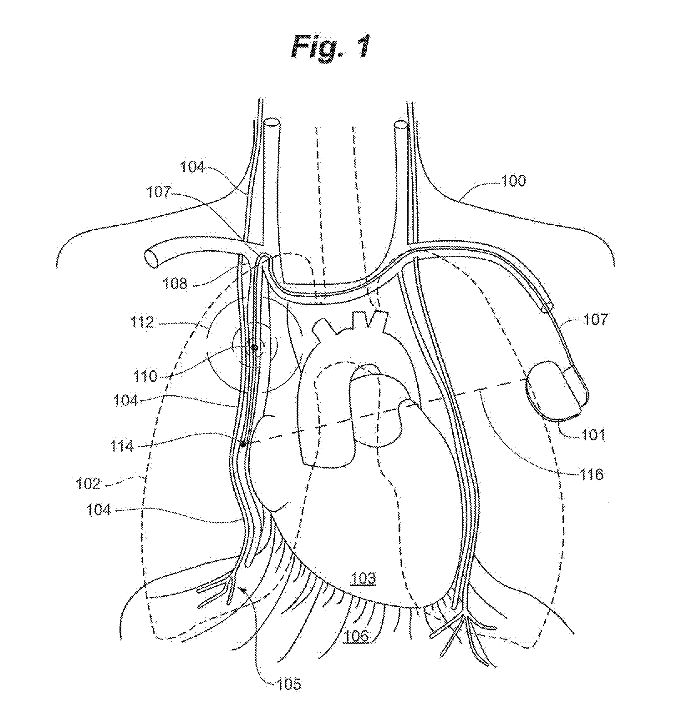 System and Method to Modulate Phrenic Nerve to Prevent Sleep Apnea