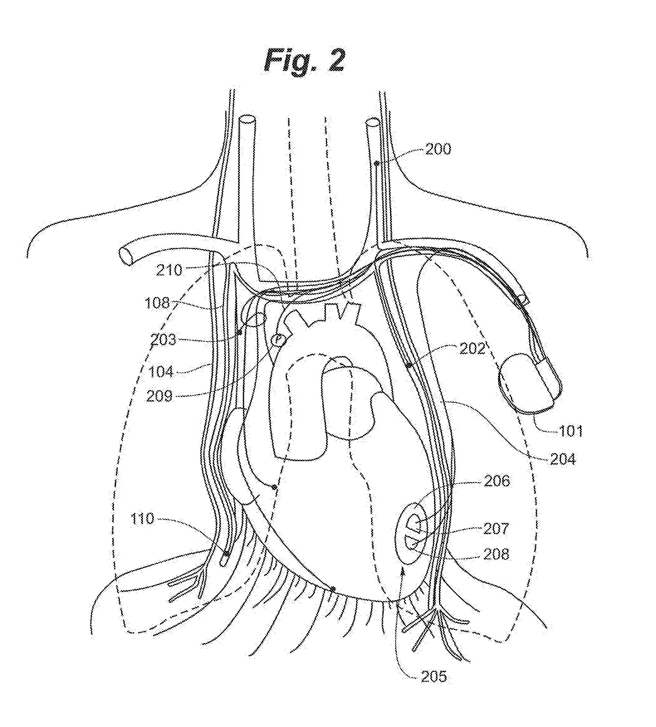 System and Method to Modulate Phrenic Nerve to Prevent Sleep Apnea