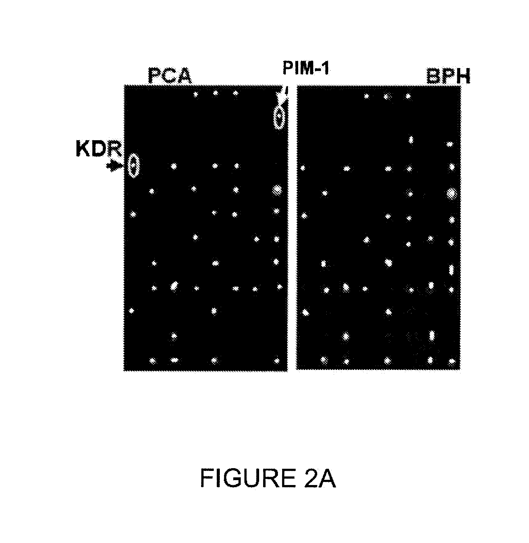 Methods and kits for detecting prostate cancer biomarkers