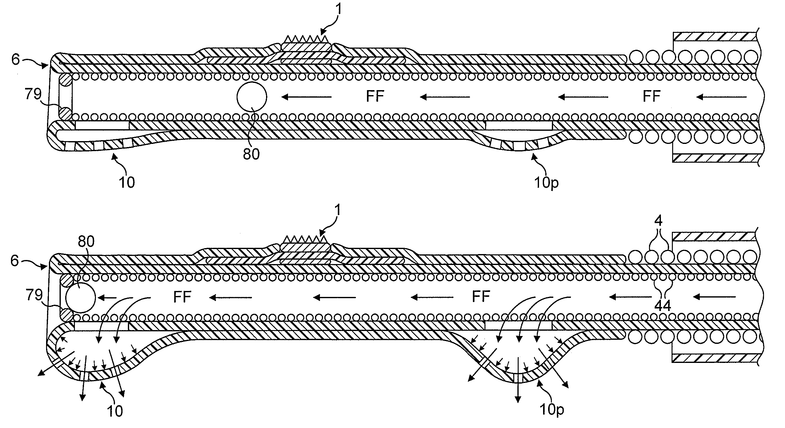 Rotational atherectomy device with fluid inflatable support elements and two torque transmitting coils
