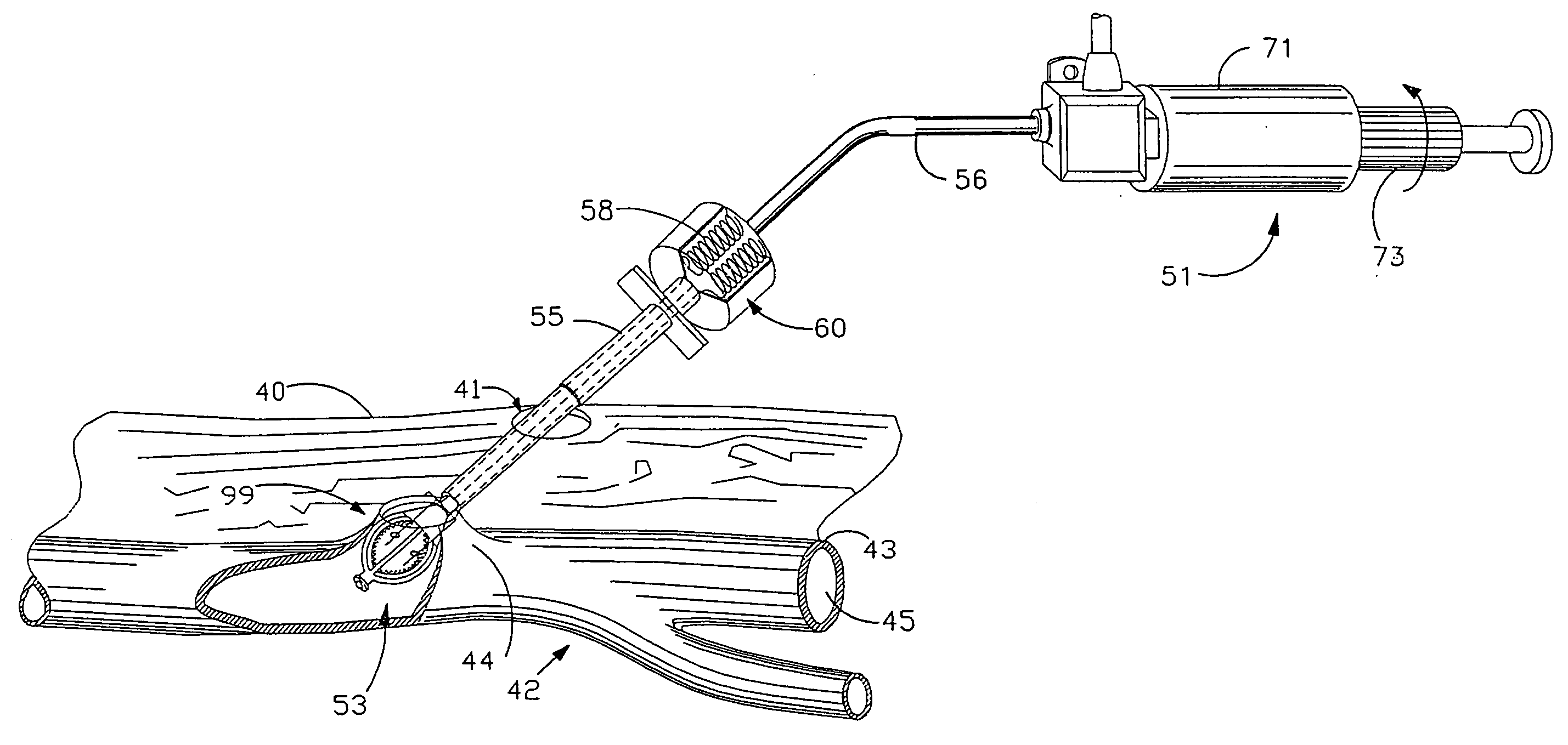 Apparatus and method for positive closure of an internal tissue membrane opening