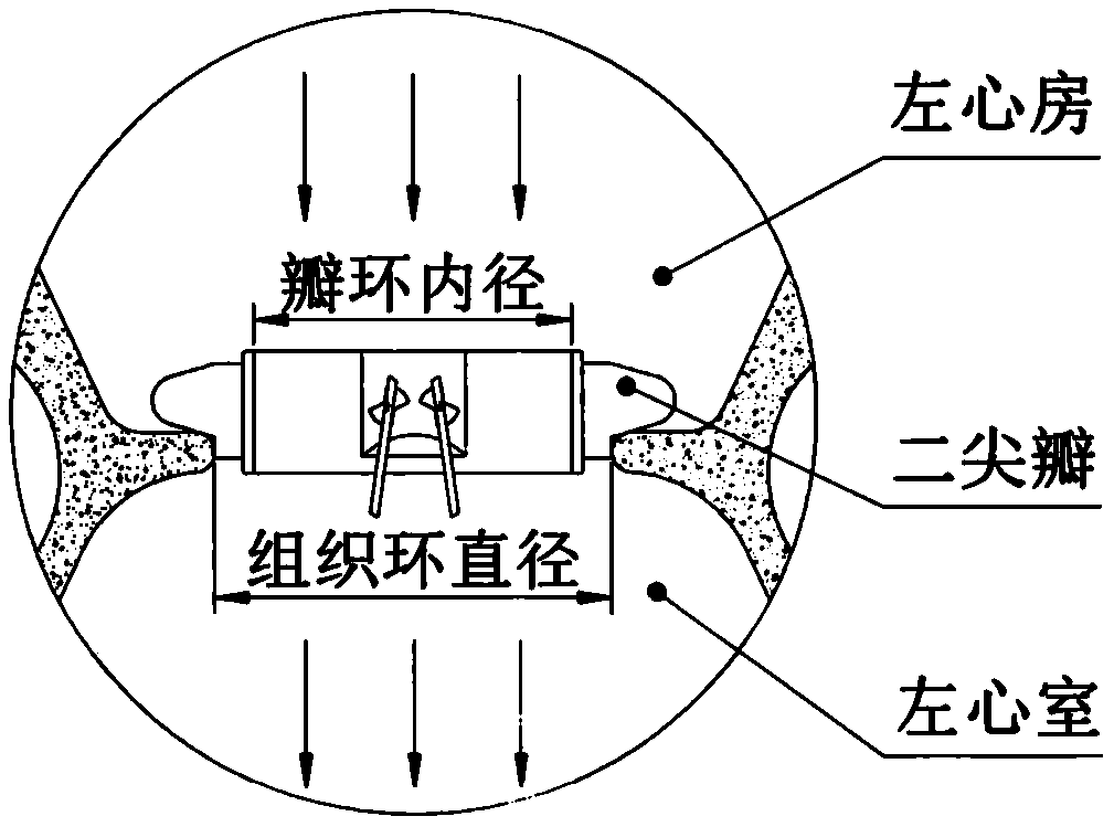 On-ring p heart valve prosthesis