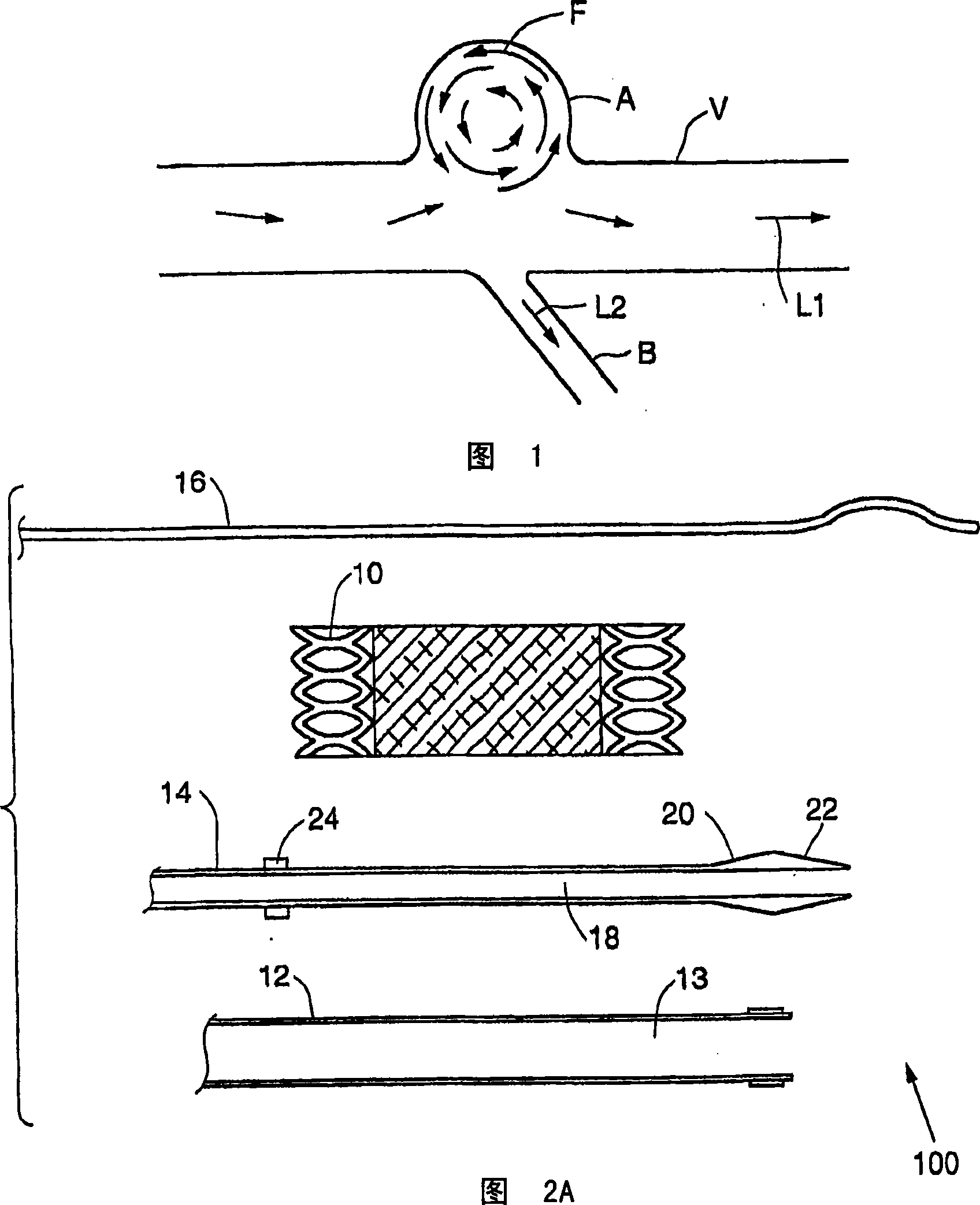 Aneurysm occlusion system and method