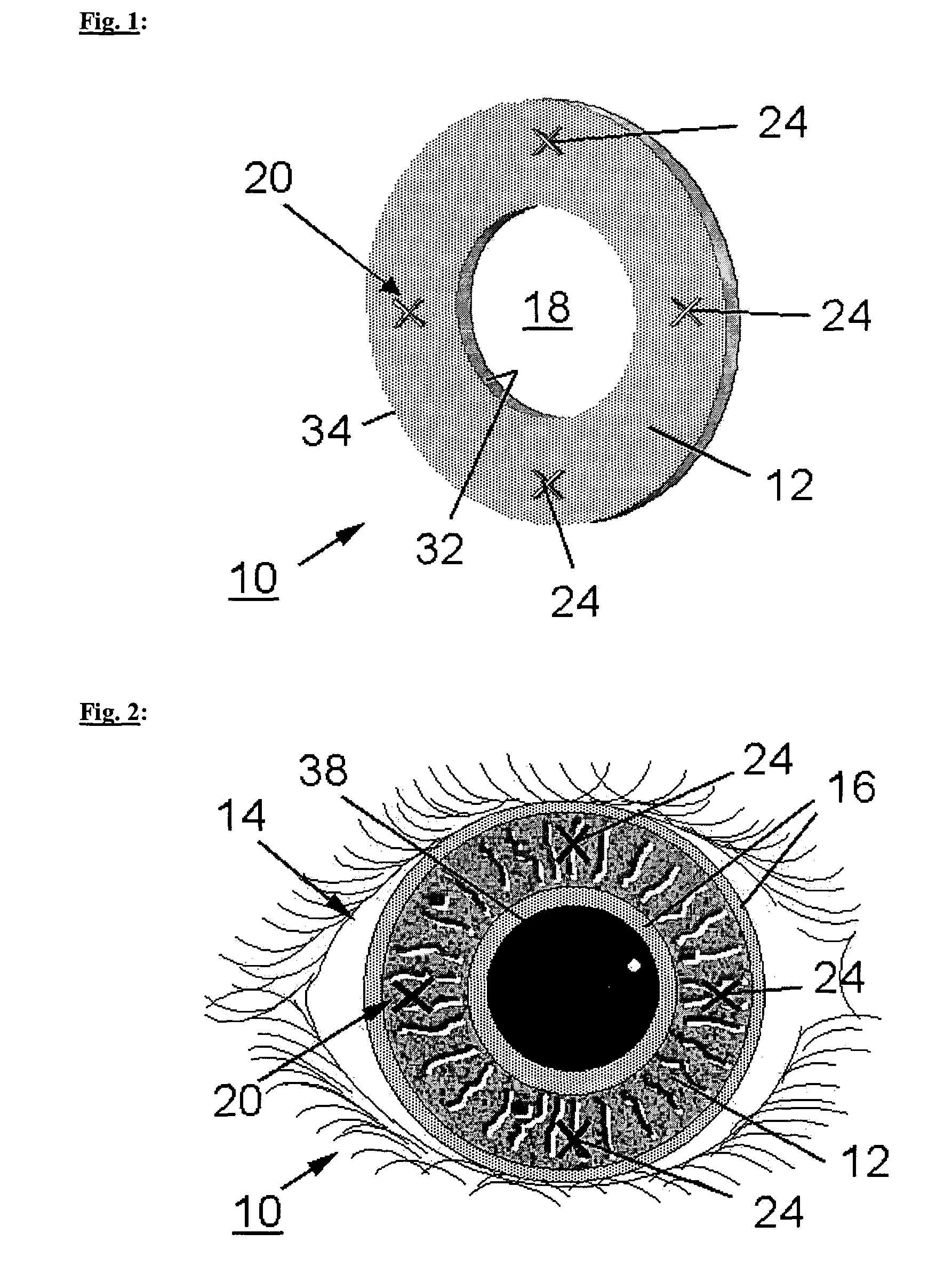 Implant for altering the iris color and method of locating and fixing an implant for altering the iris color