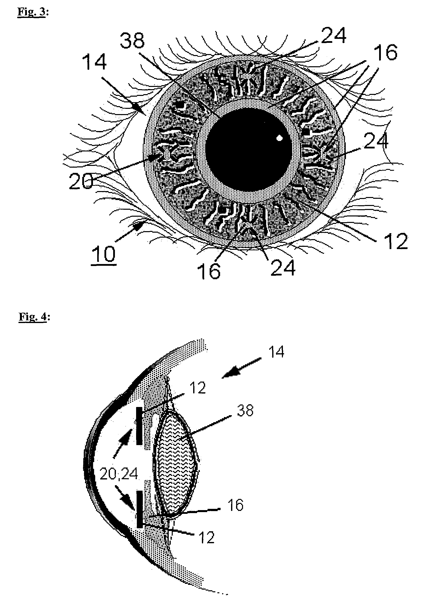 Implant for altering the iris color and method of locating and fixing an implant for altering the iris color