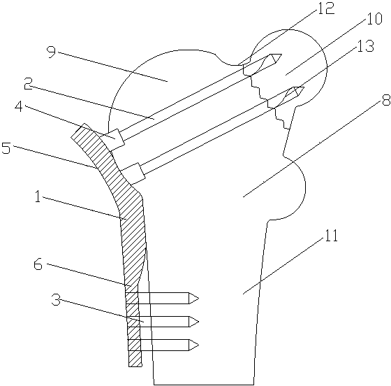 Bone connecting device for treating femoral neck fracture