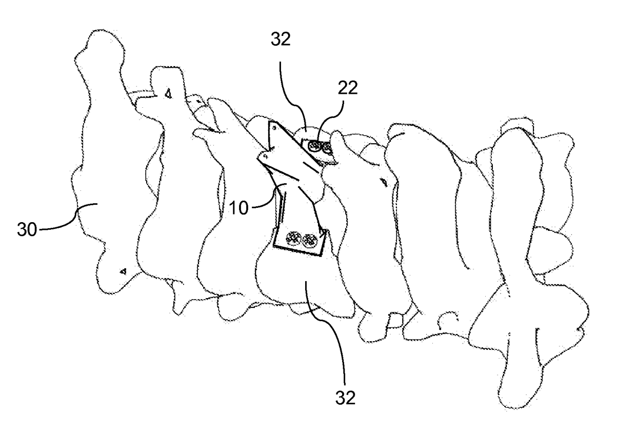 Total artificial spino-laminar prosthetic replacement