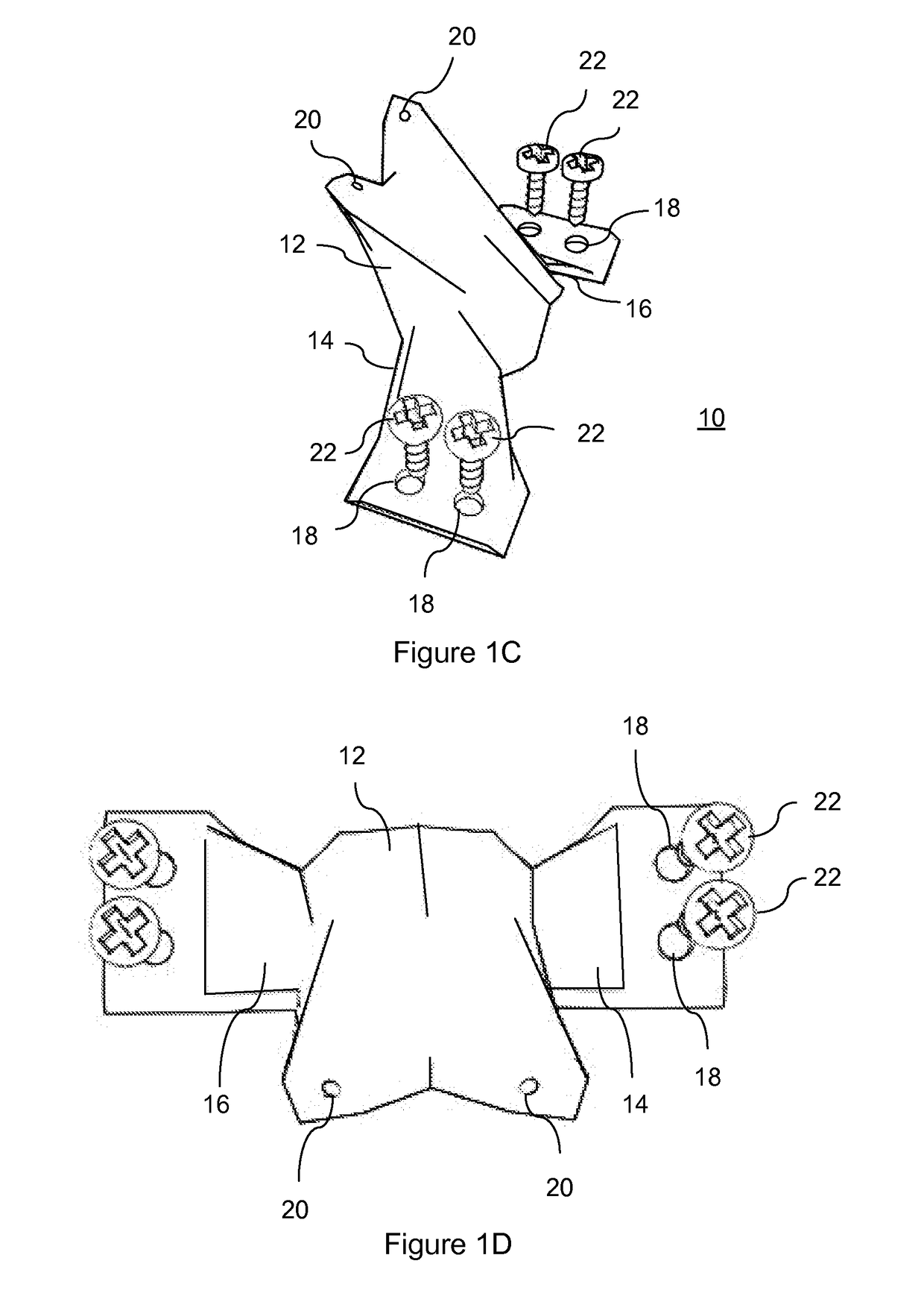 Total artificial spino-laminar prosthetic replacement