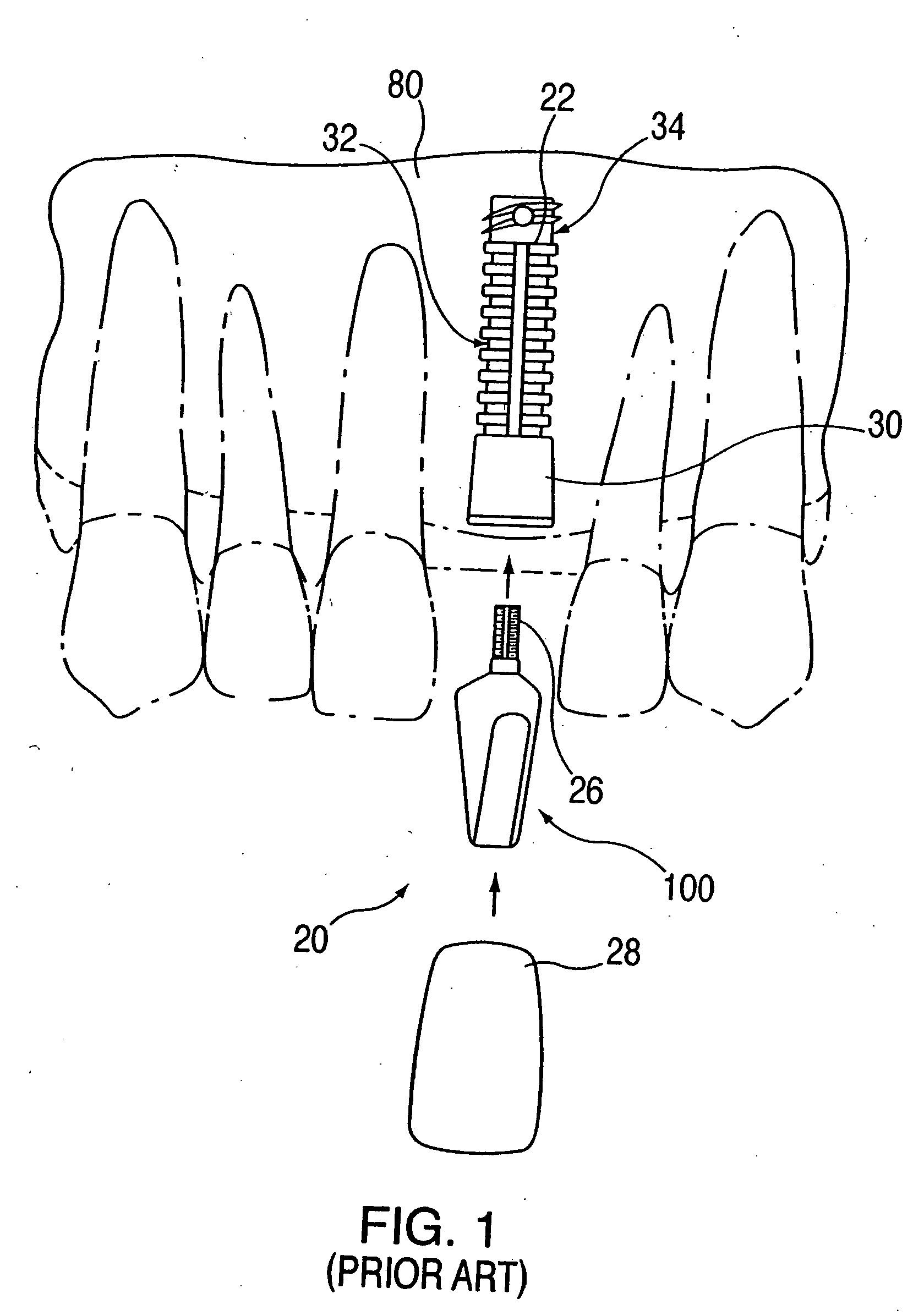 Combination distraction dental implant and method of use