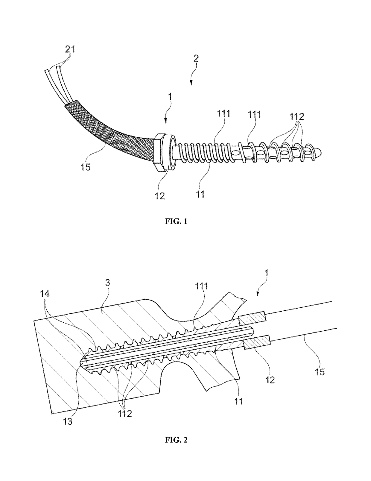 Cannulated bone screw and methods of use therefof