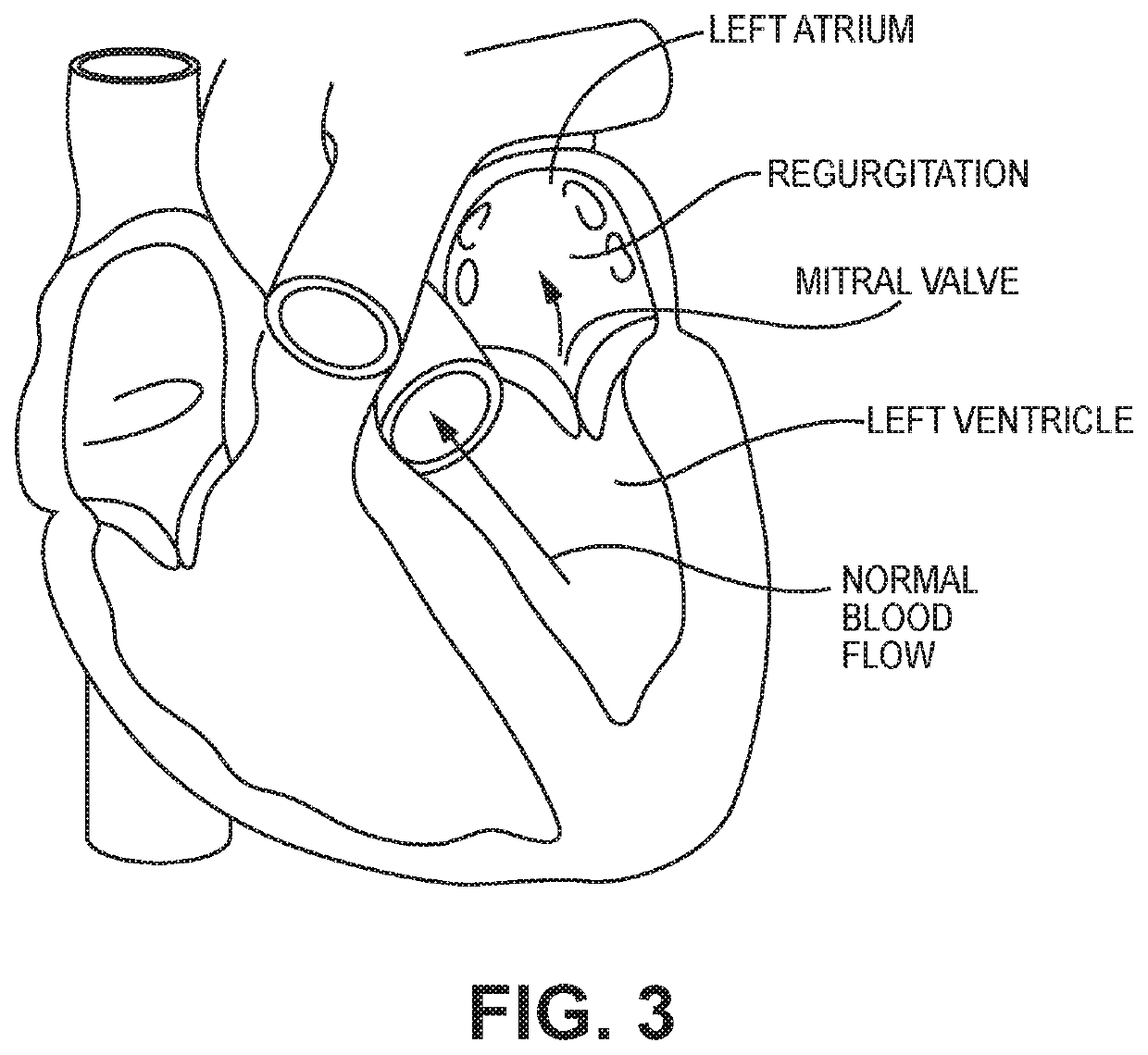 Hydrophilic skirt for paravalvular leak mitigation and fit and apposition optimization for prosthetic heart valve implants