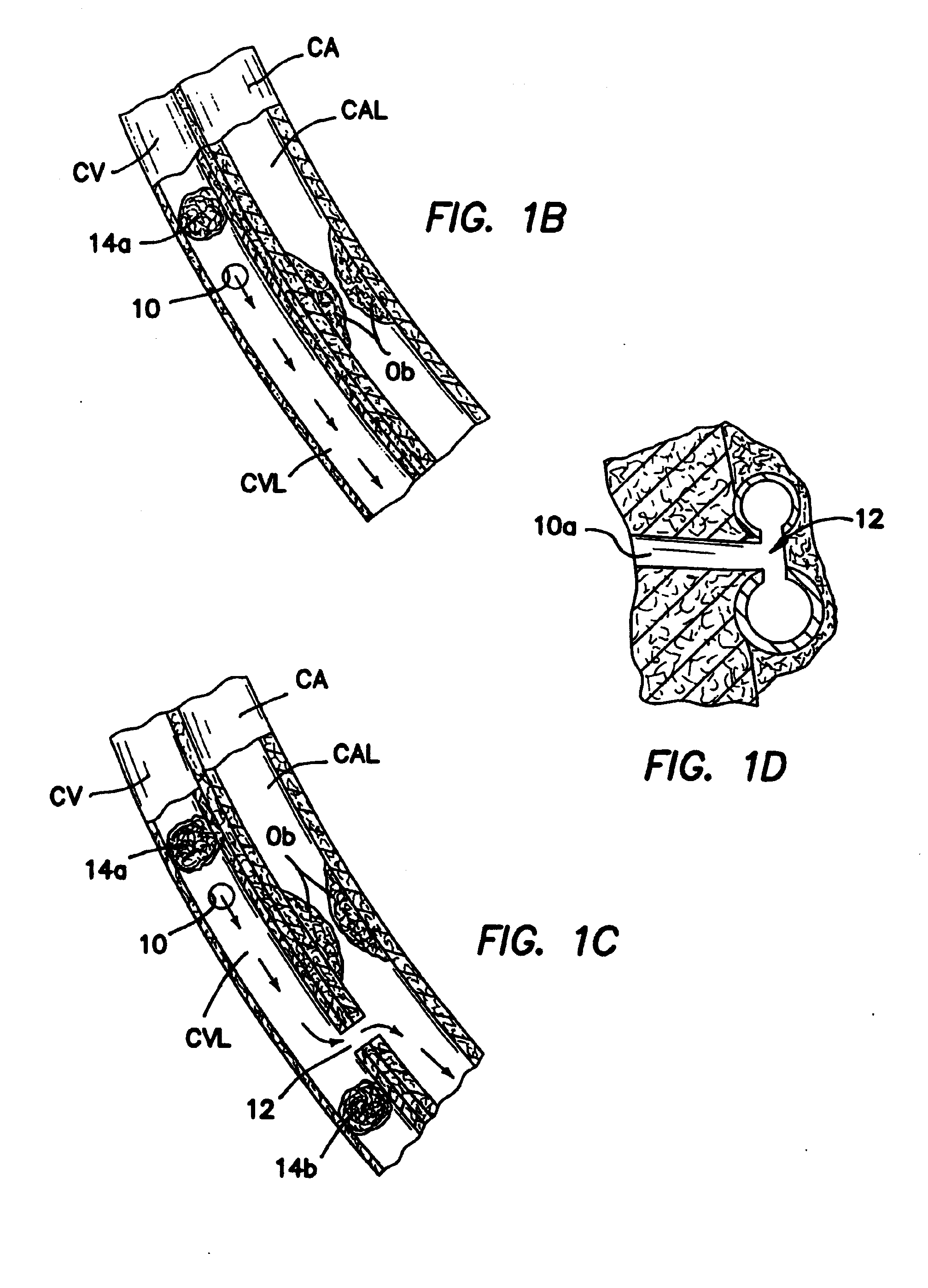 Methods and apparatus for transmyocardial direct coronary revascularization