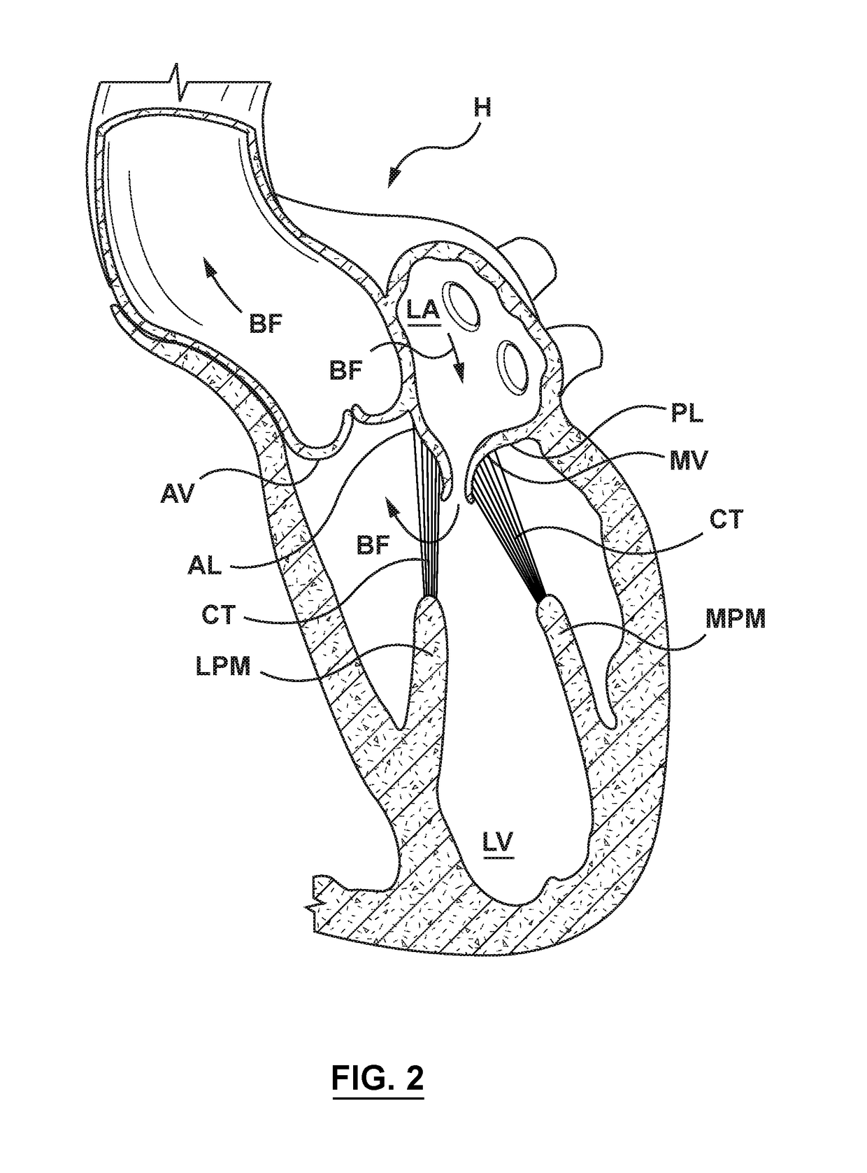 Chordae tendineae management devices for use with a valve prosthesis delivery system and methods of use thereof