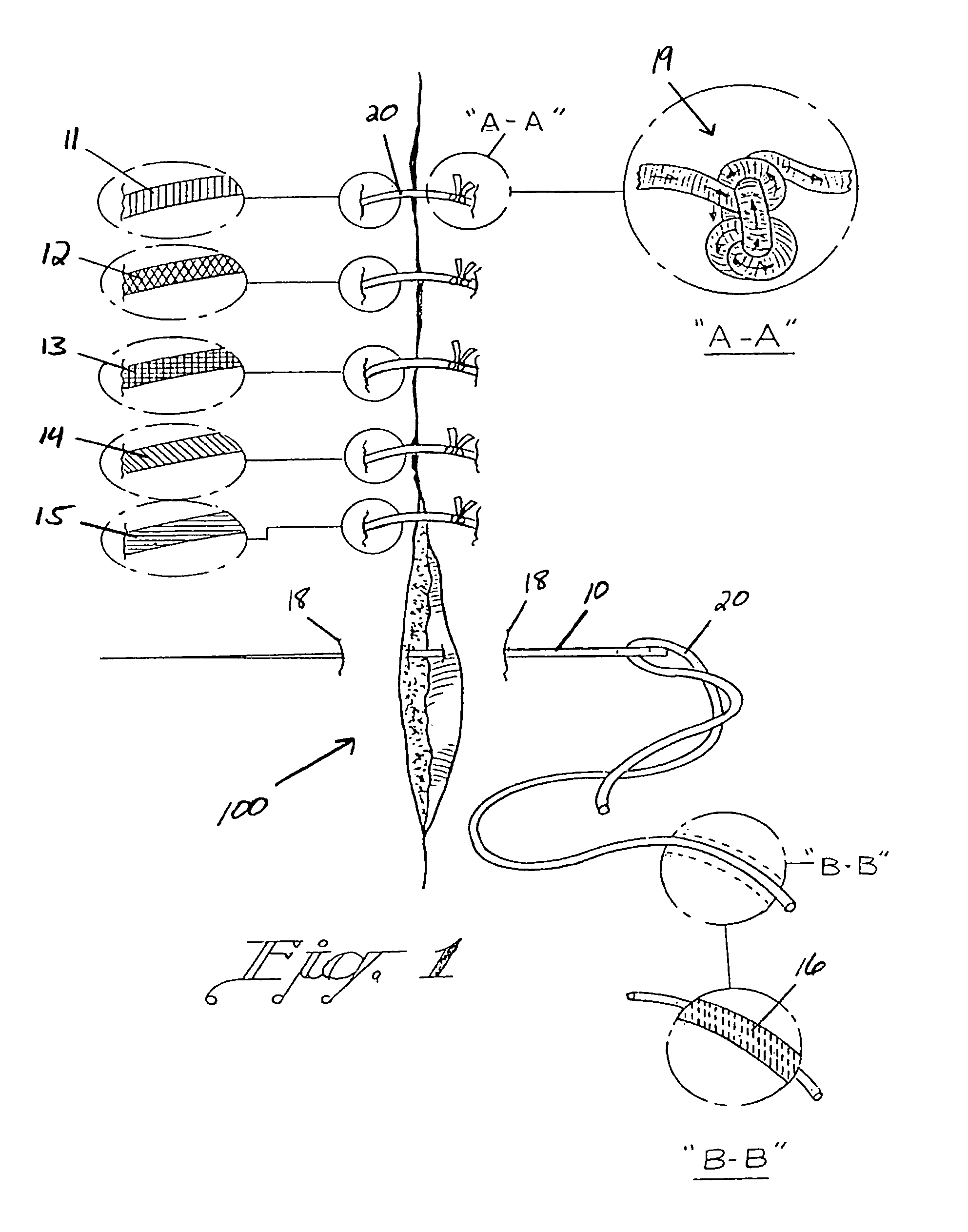Suture treatment method and suture construction/kit therefor