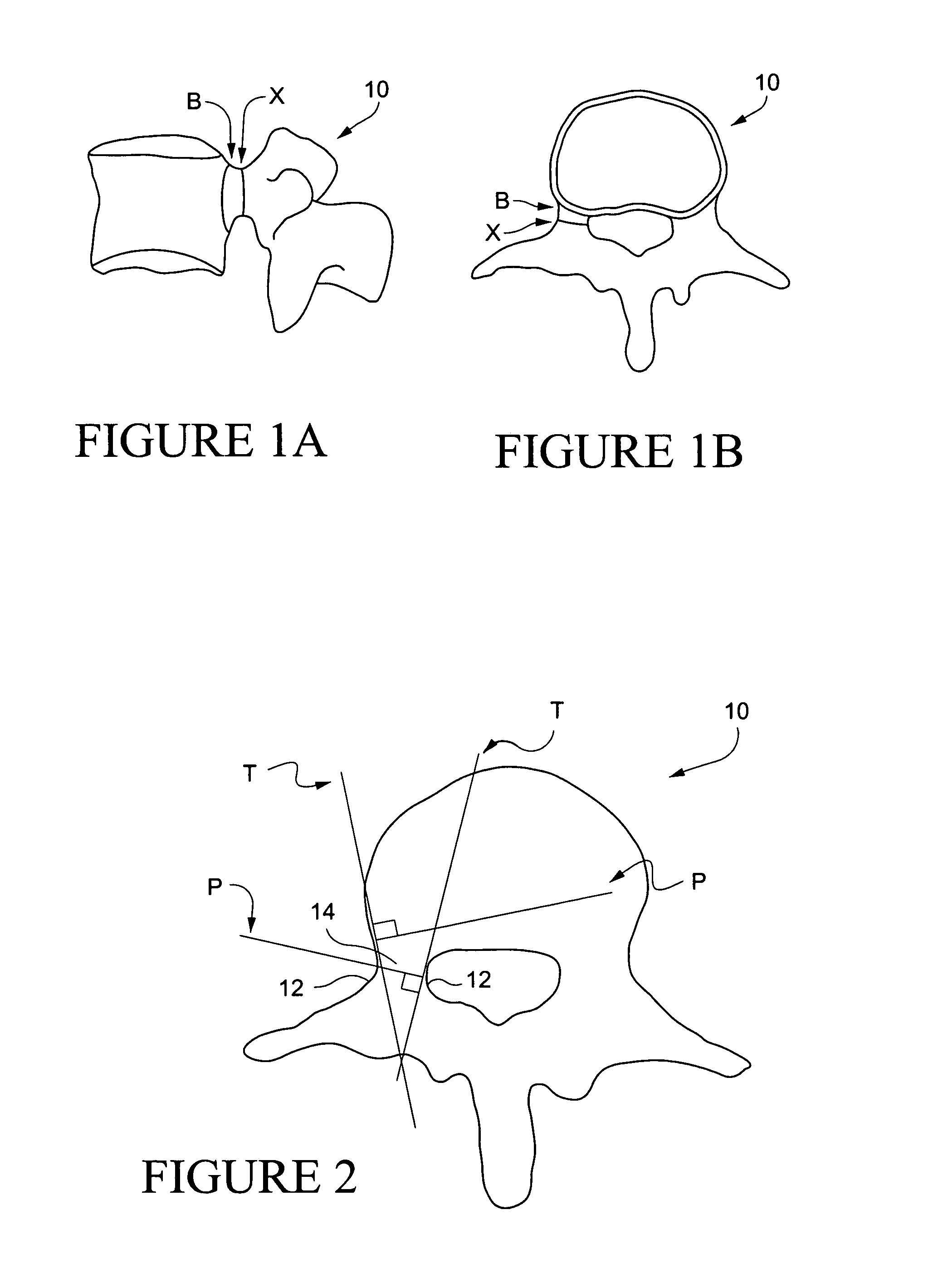 Methods for determining pedicle base circumference, pedicle isthmus and center of the pedicle isthmus for pedicle screw or instrument placement in spinal surgery