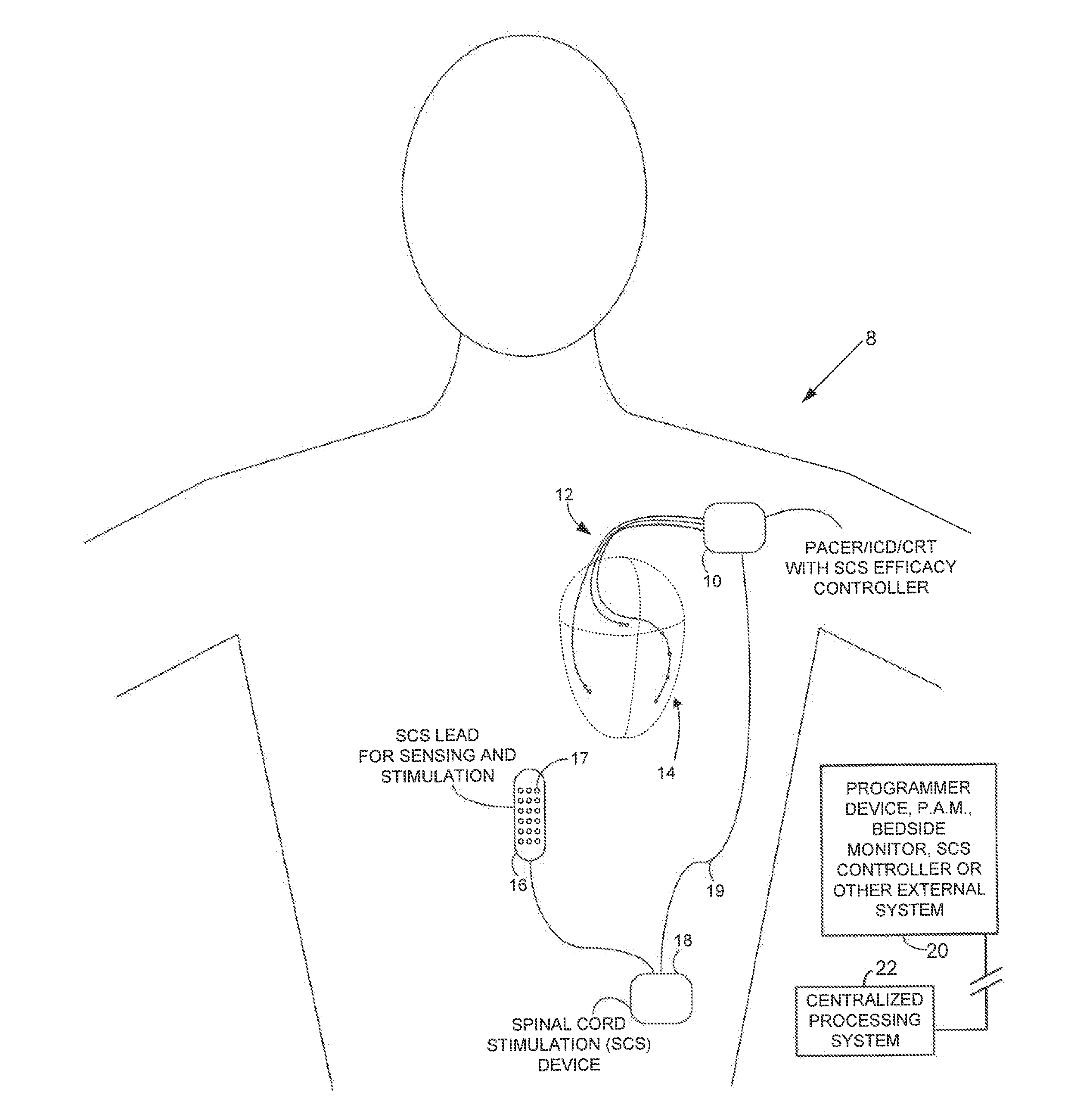 Systems and methods for controlling spinal cord stimulation to improve stimulation efficacy for use by implantable medical devices