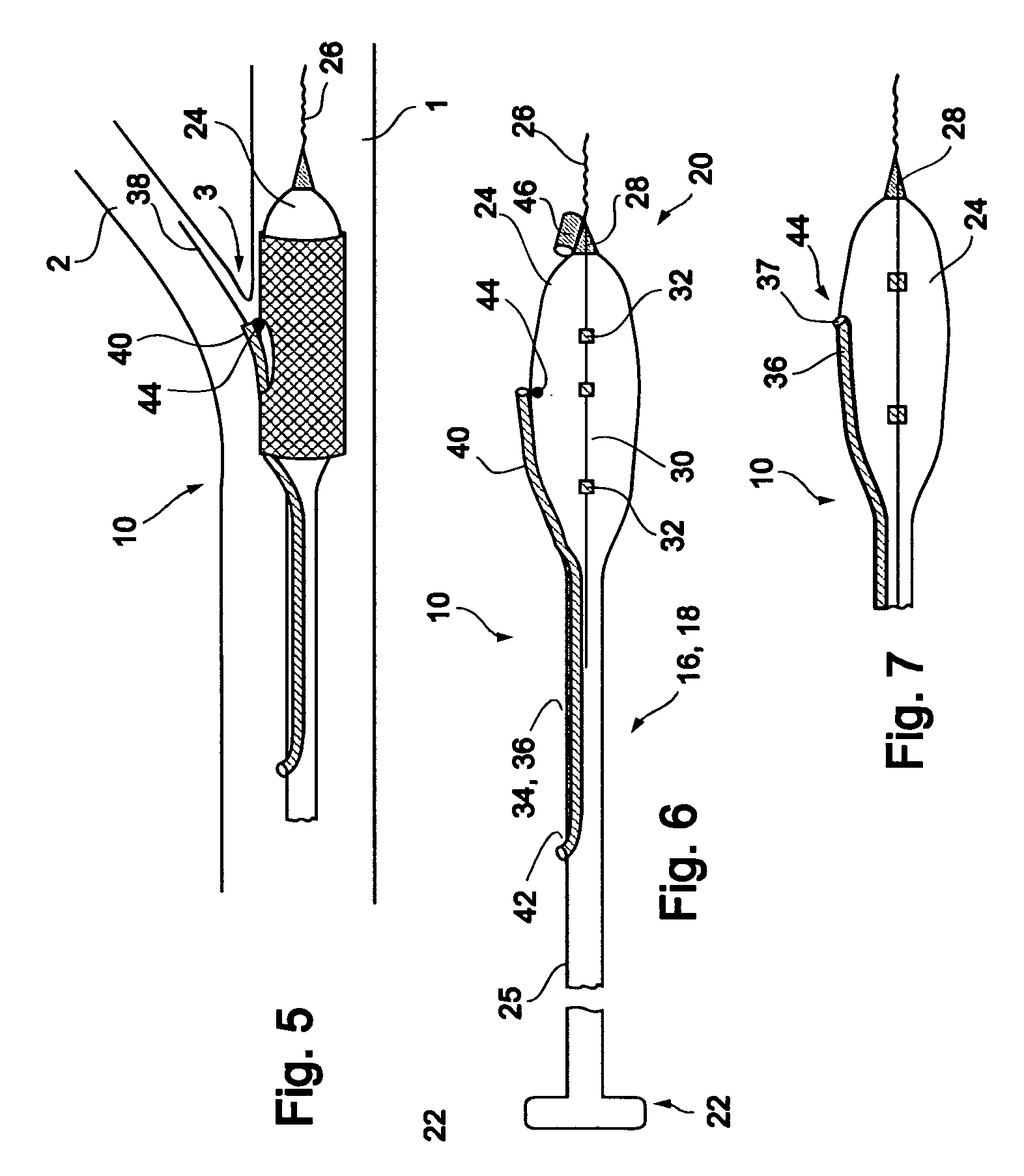 Vessel treatment devices