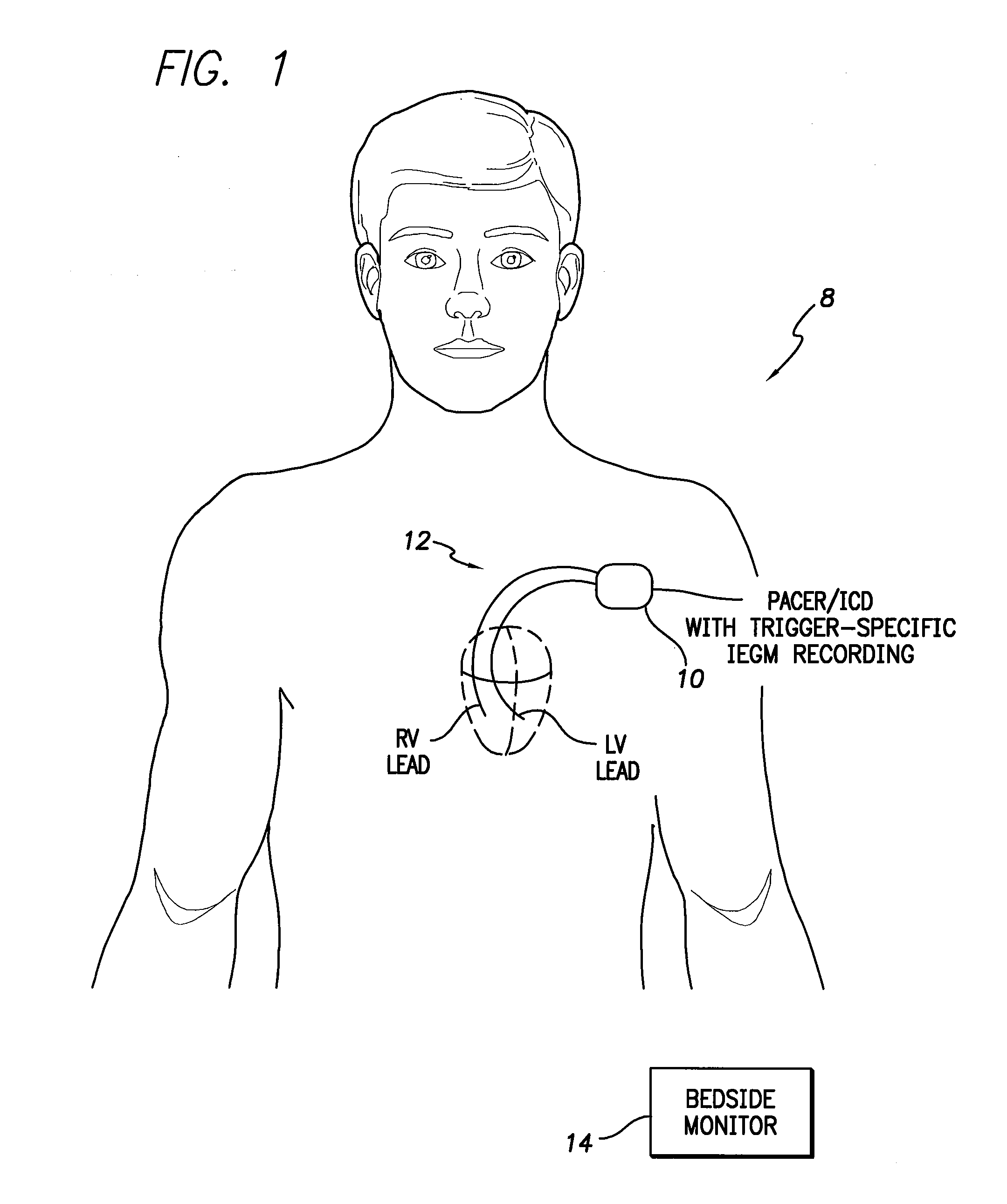 System and method for trigger-specific recording of cardiac signals using an implantable medical device