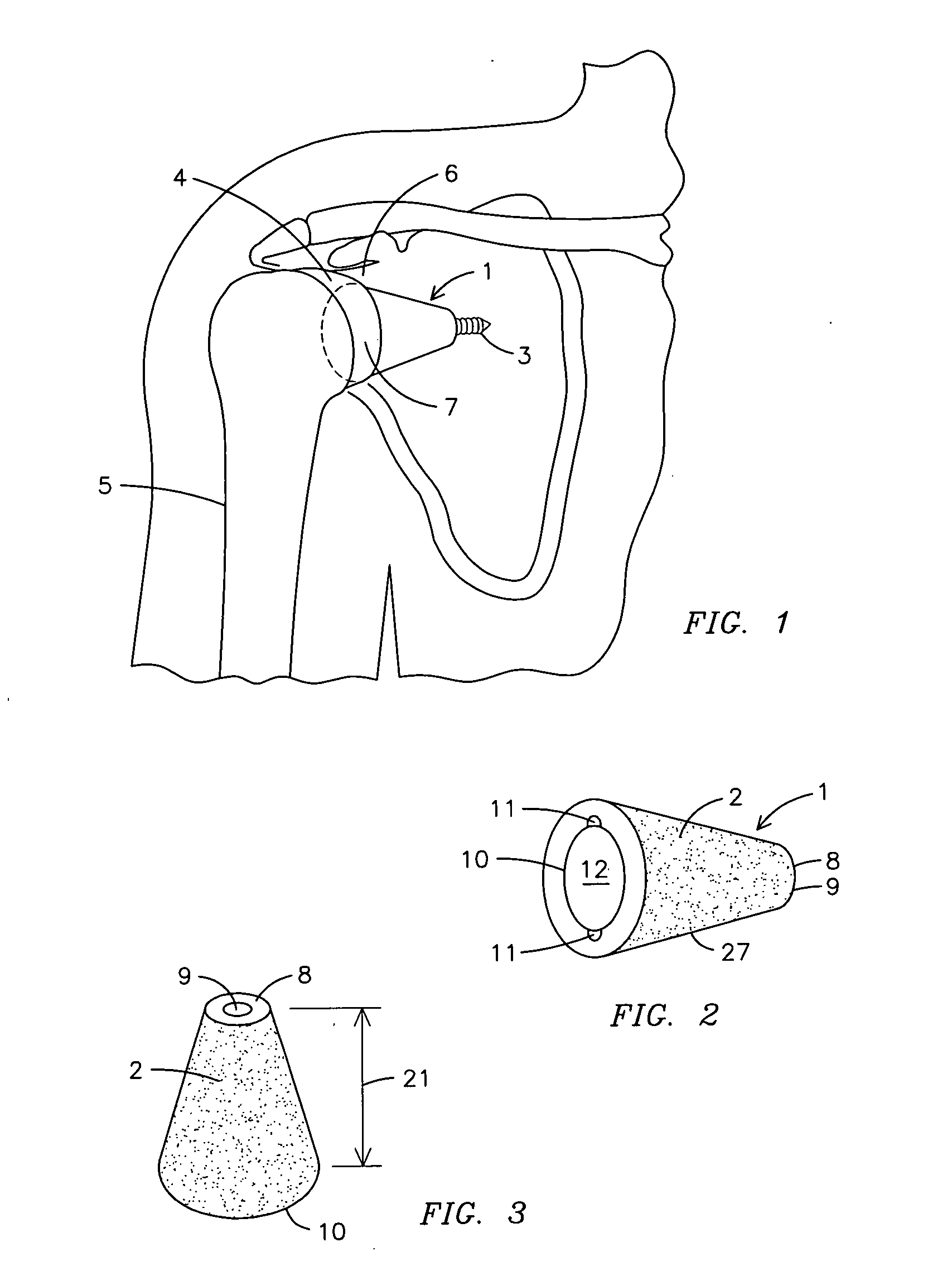 Conically-shaped glenoid implant with a prosthetic glenoid insert used in total shoulder arthroplasty and method
