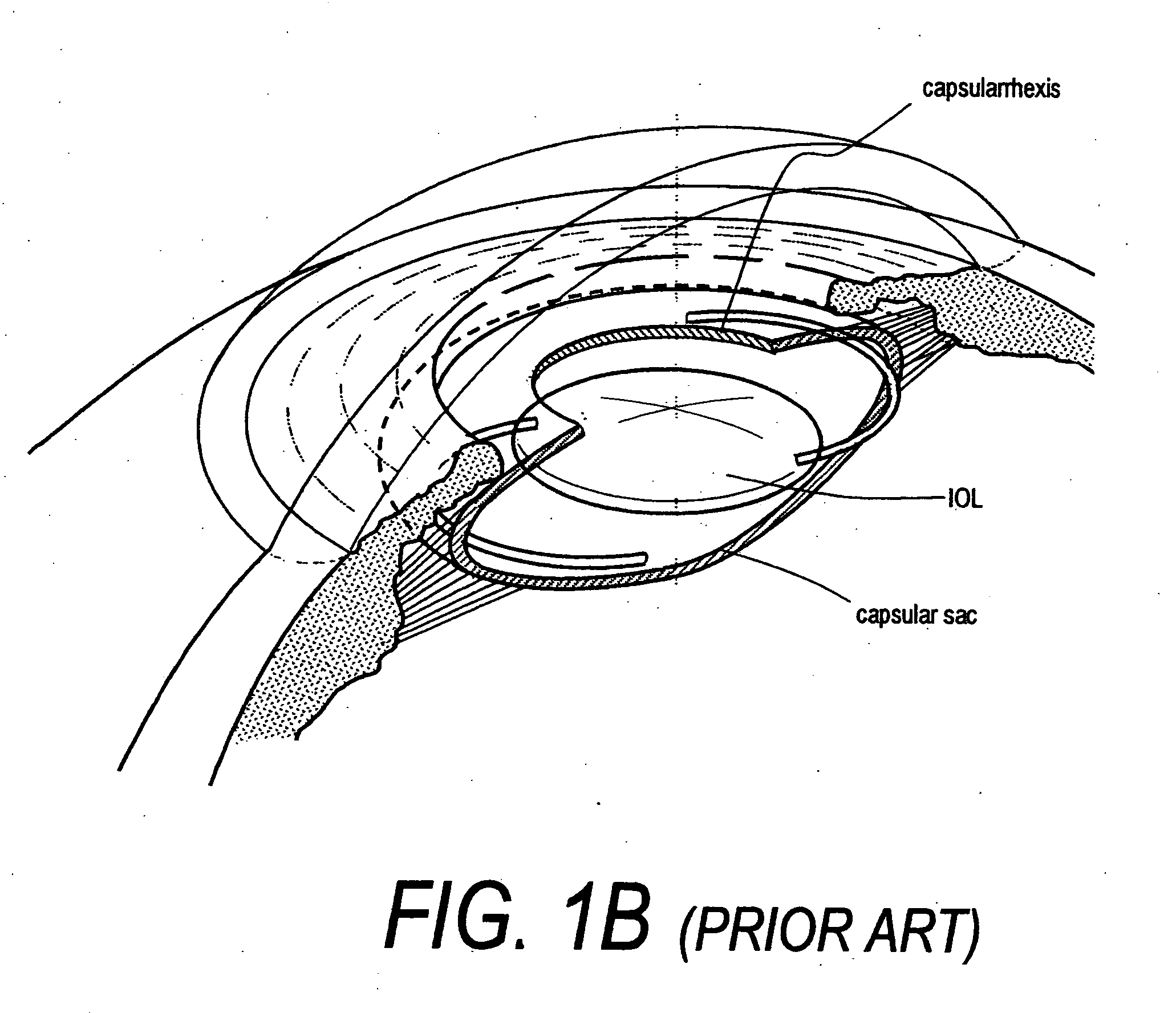 Intraocular lenses and business methods