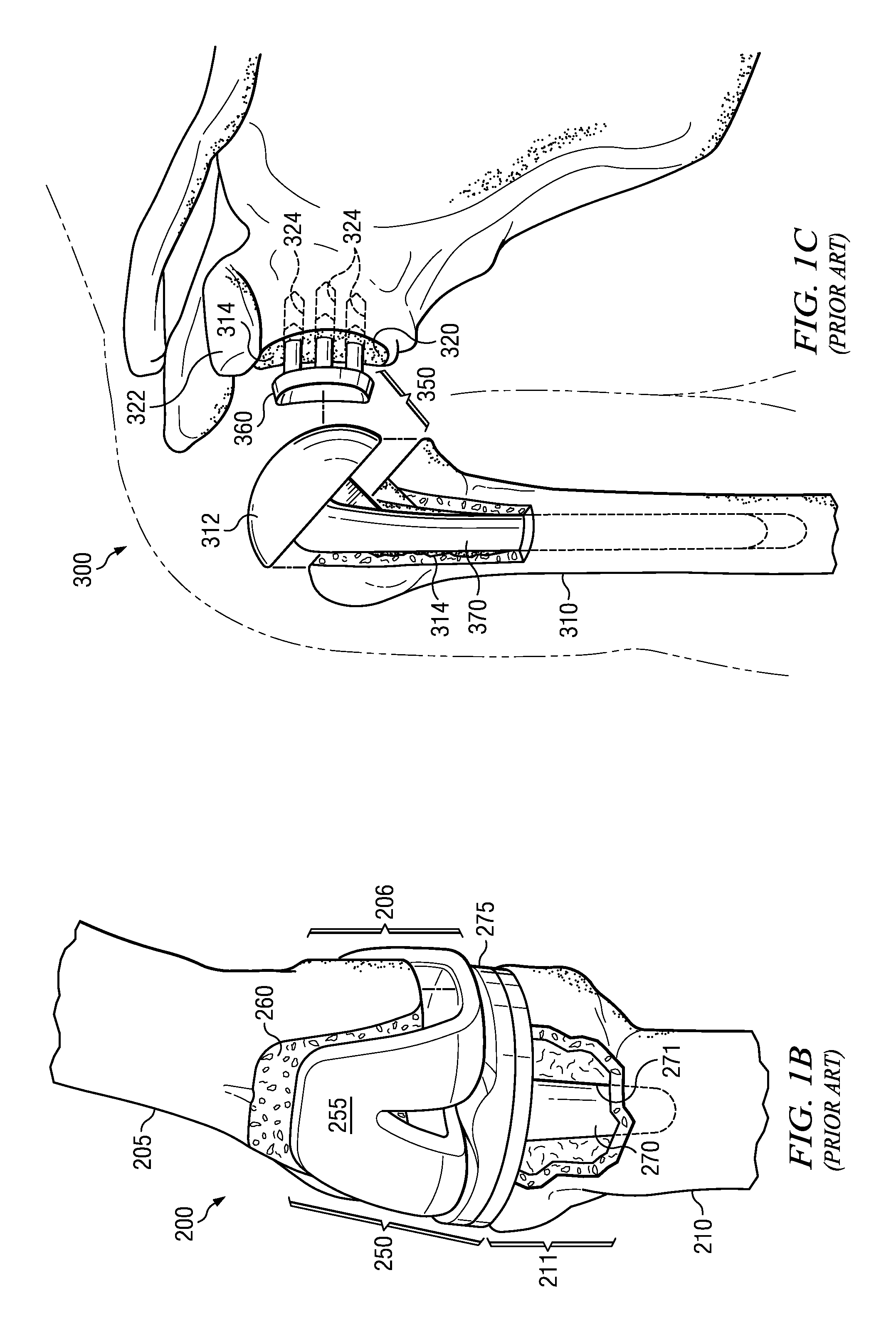 Electrosurgical system and method for treating hard body tissue