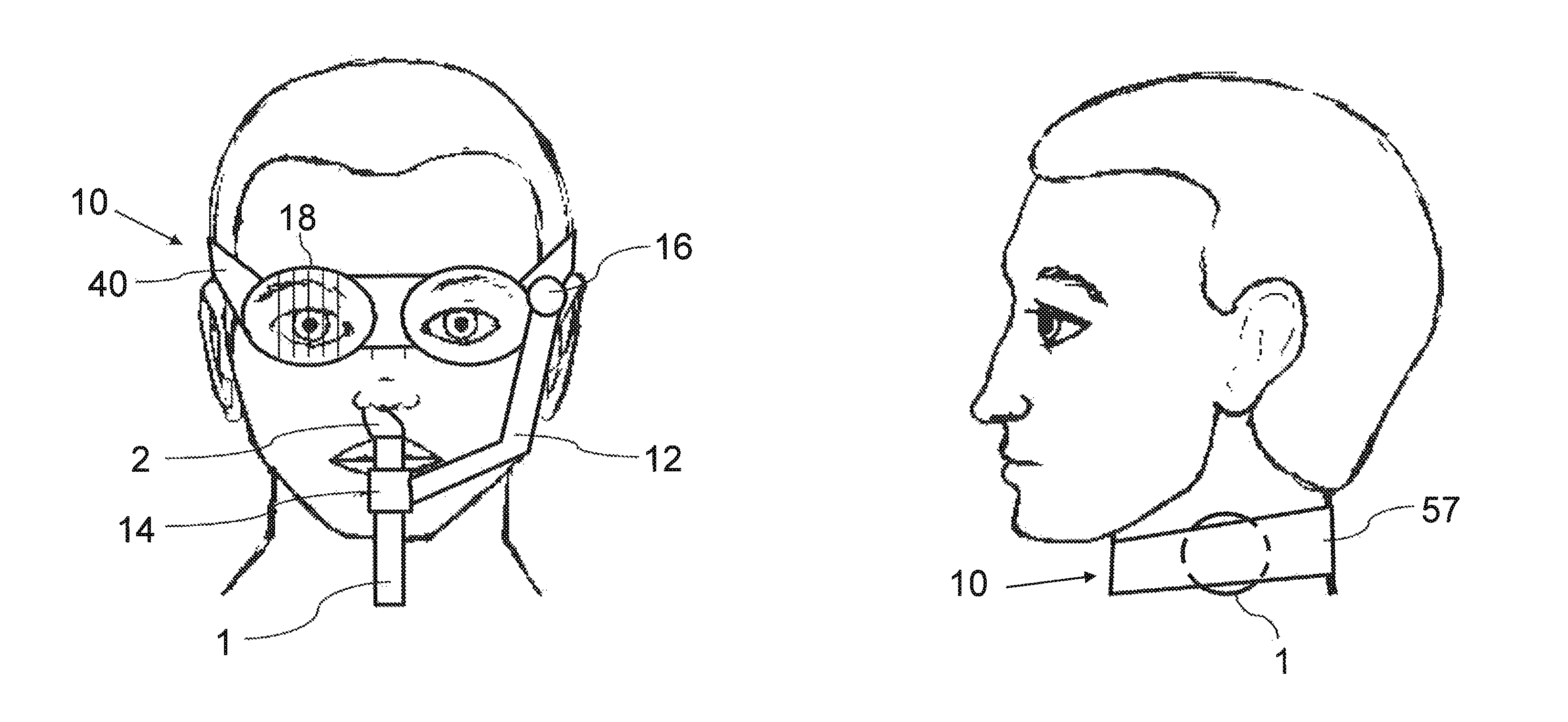 ALS treatment