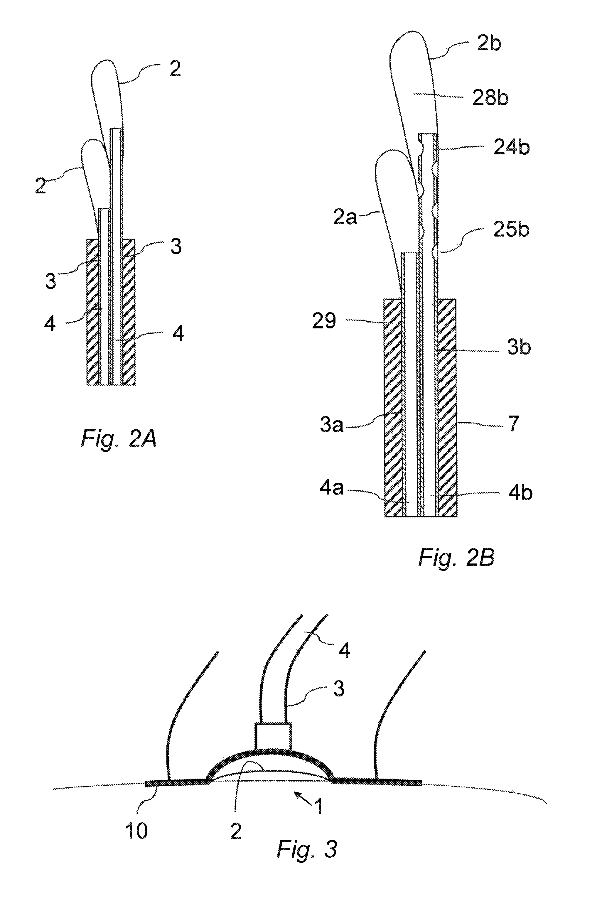 ALS treatment