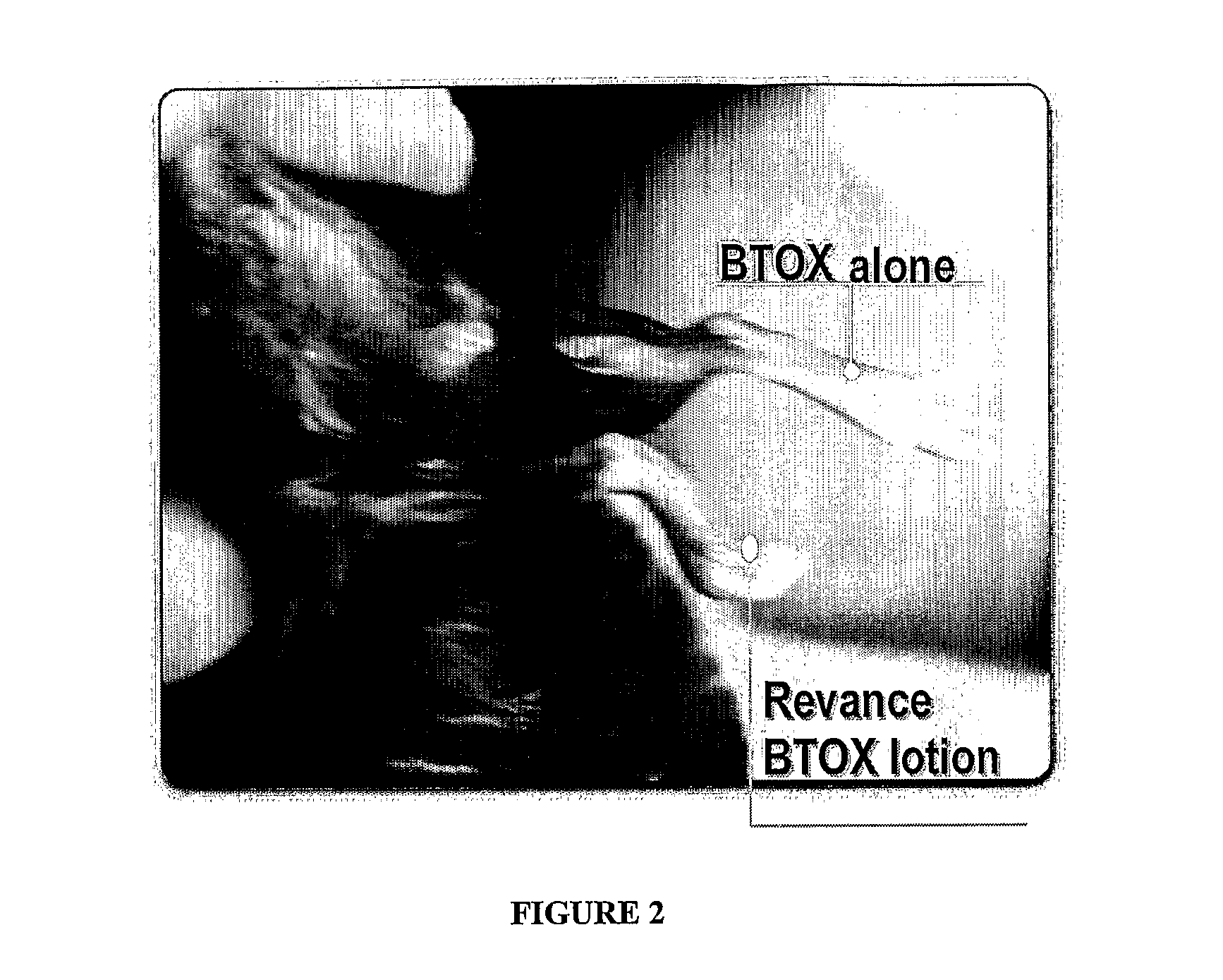 Compositions and Methods for Topical Application and Transdermal Delivery of Botulinum Toxins