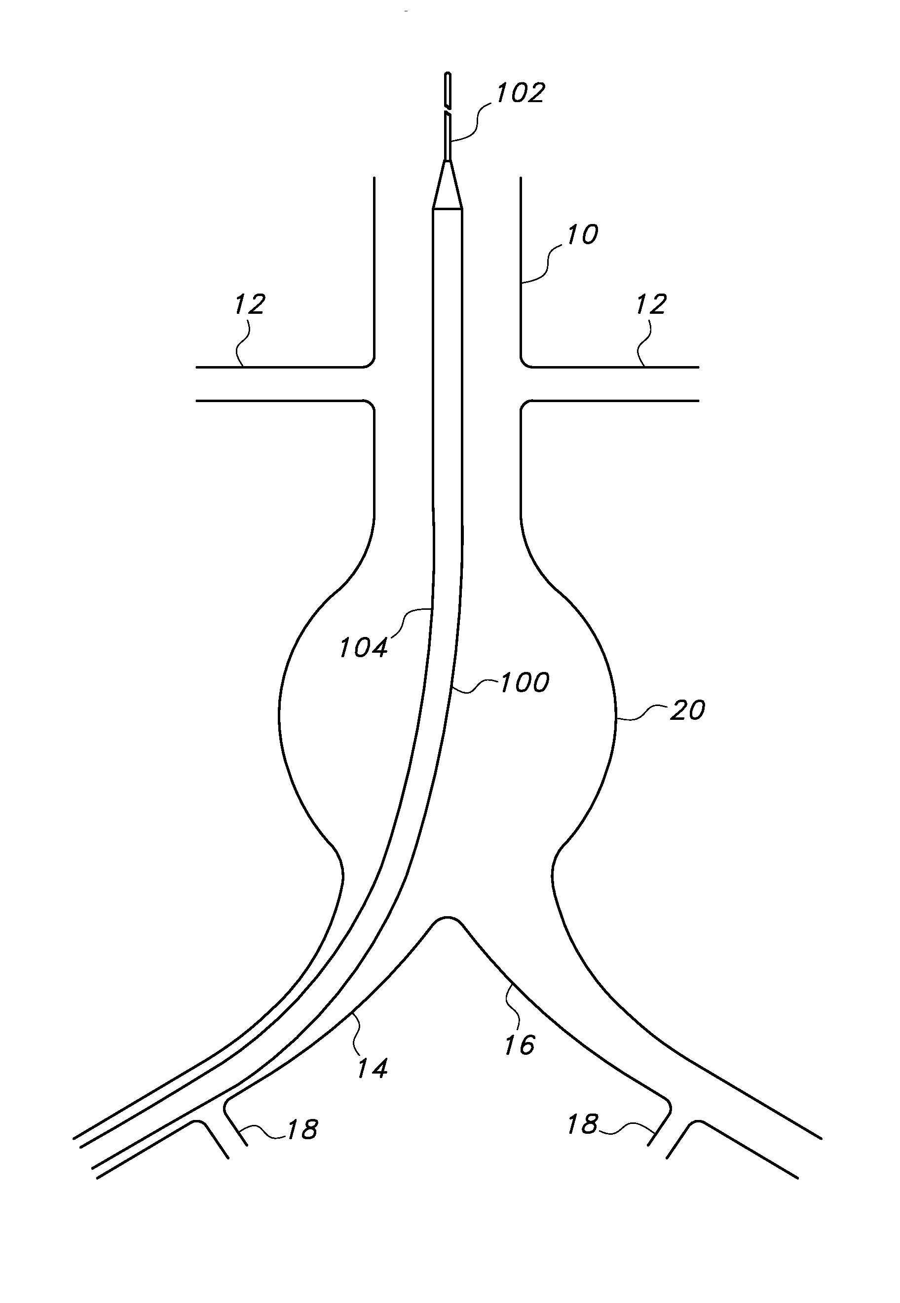 Endovascular delivery system with flexible and torqueable hypotube