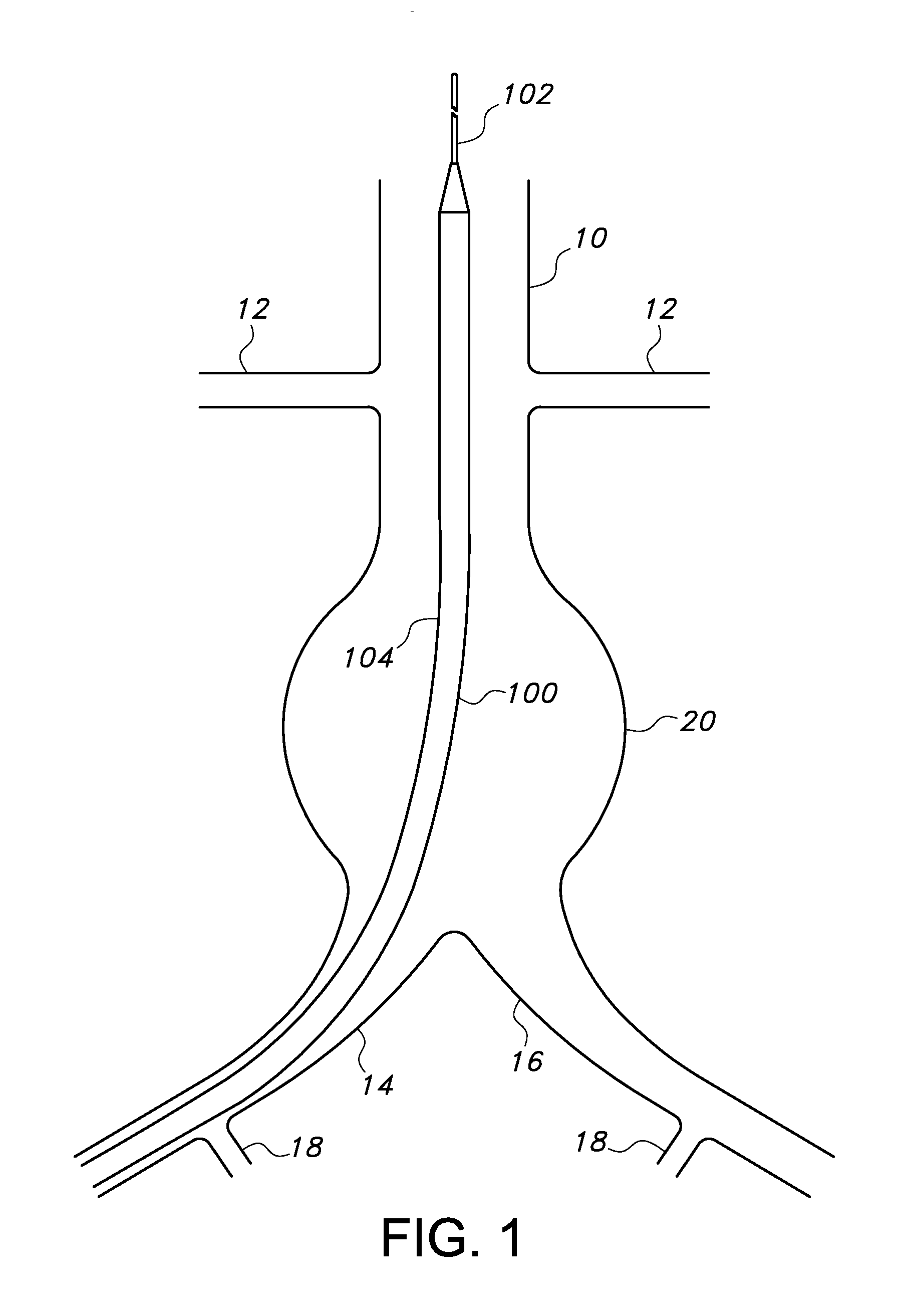 Endovascular delivery system with flexible and torqueable hypotube