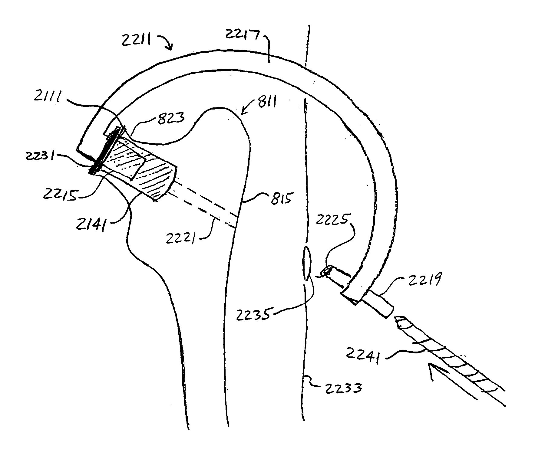 Method of implanting a femoral neck fixation prosthesis