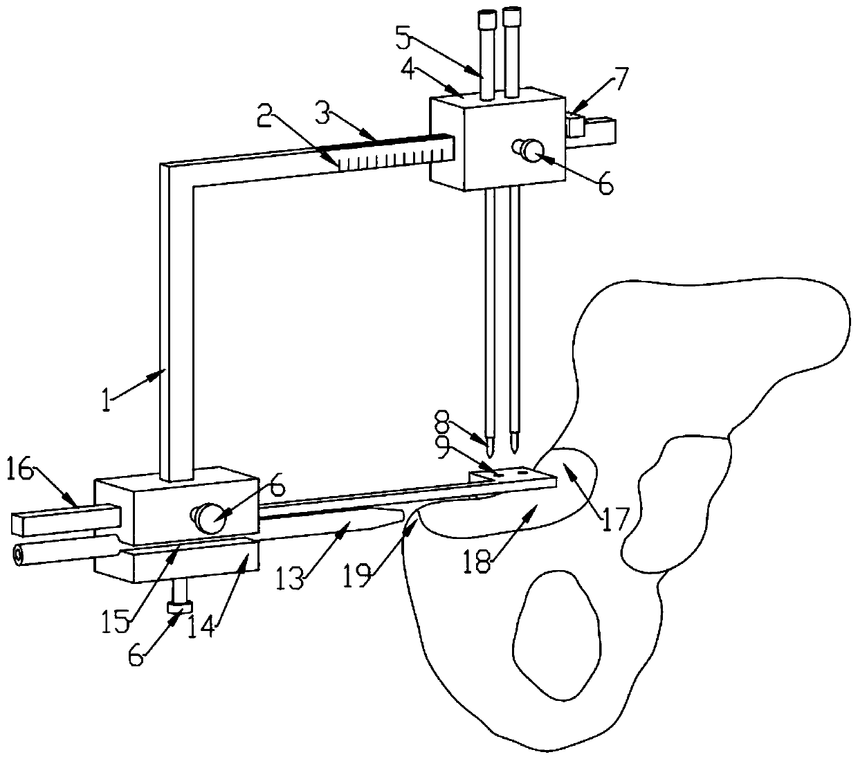 Double-plane vertical fixed point staggered distance-acetabulum anterior column screw minimally invasive positioning and guiding device