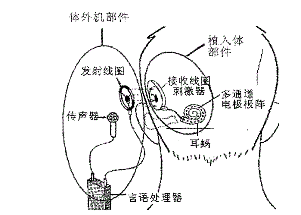 Artificial electronic cochlea and method for processing speech with double stimulation rates