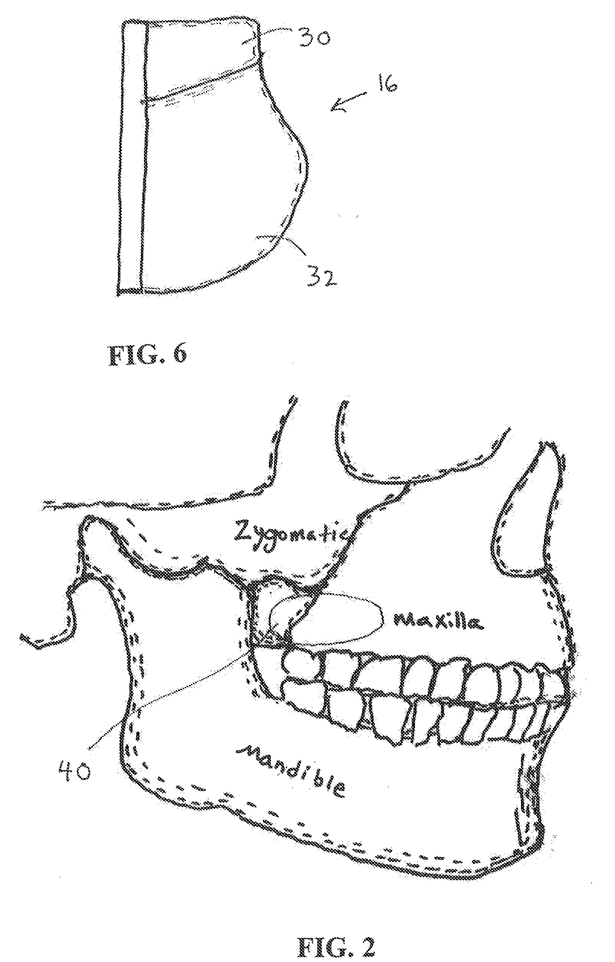 Method and device for nasal dilation by applying force to a target cheek area without mandibular displacement