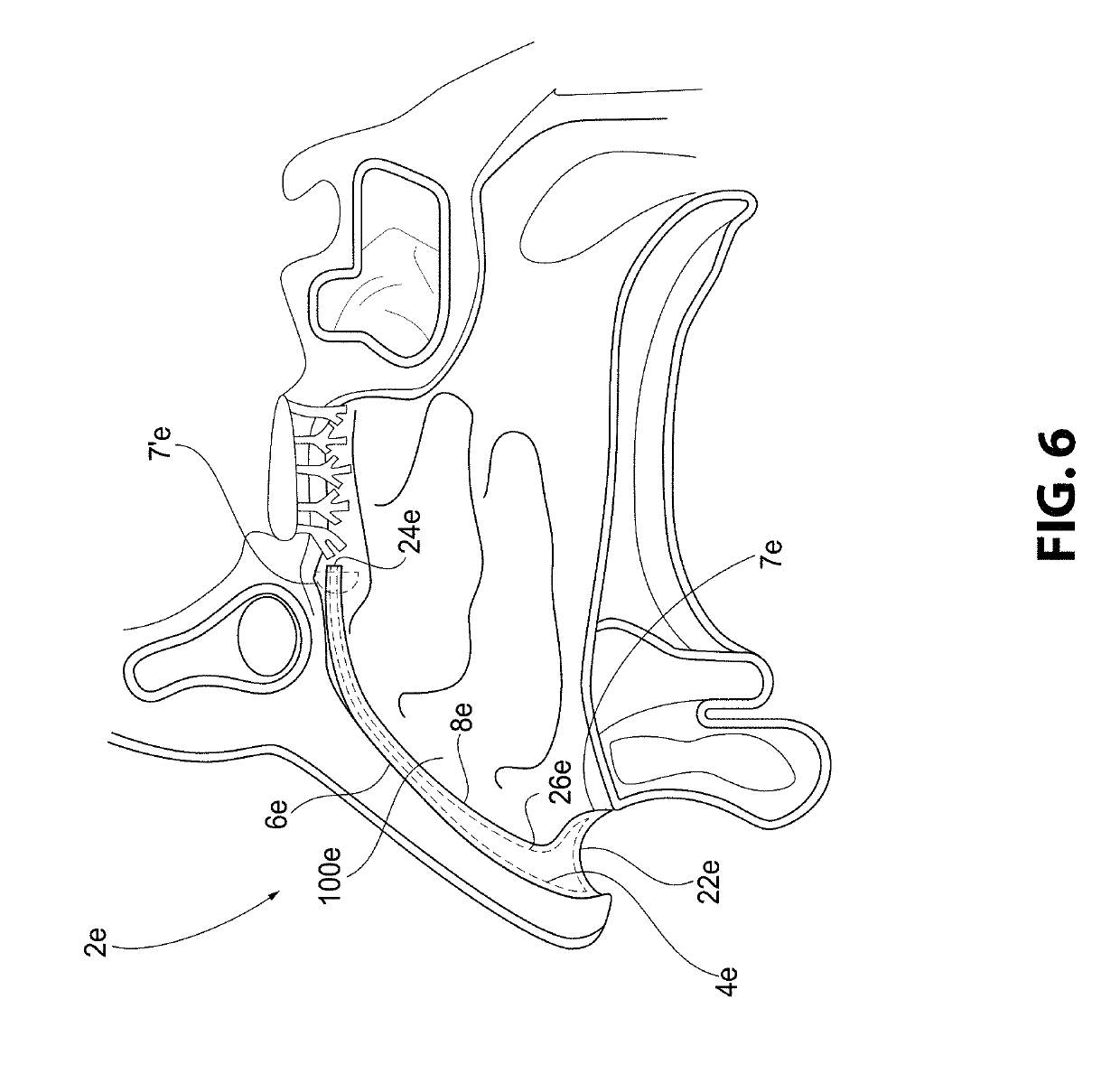 Nasal Device for Treatment