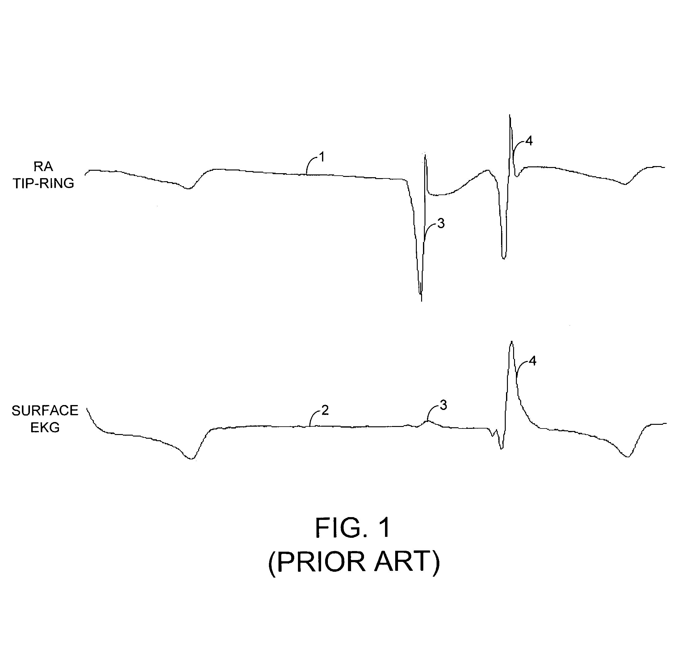 System and method for rejecting far-field signals using an implantable cardiac stimulation device