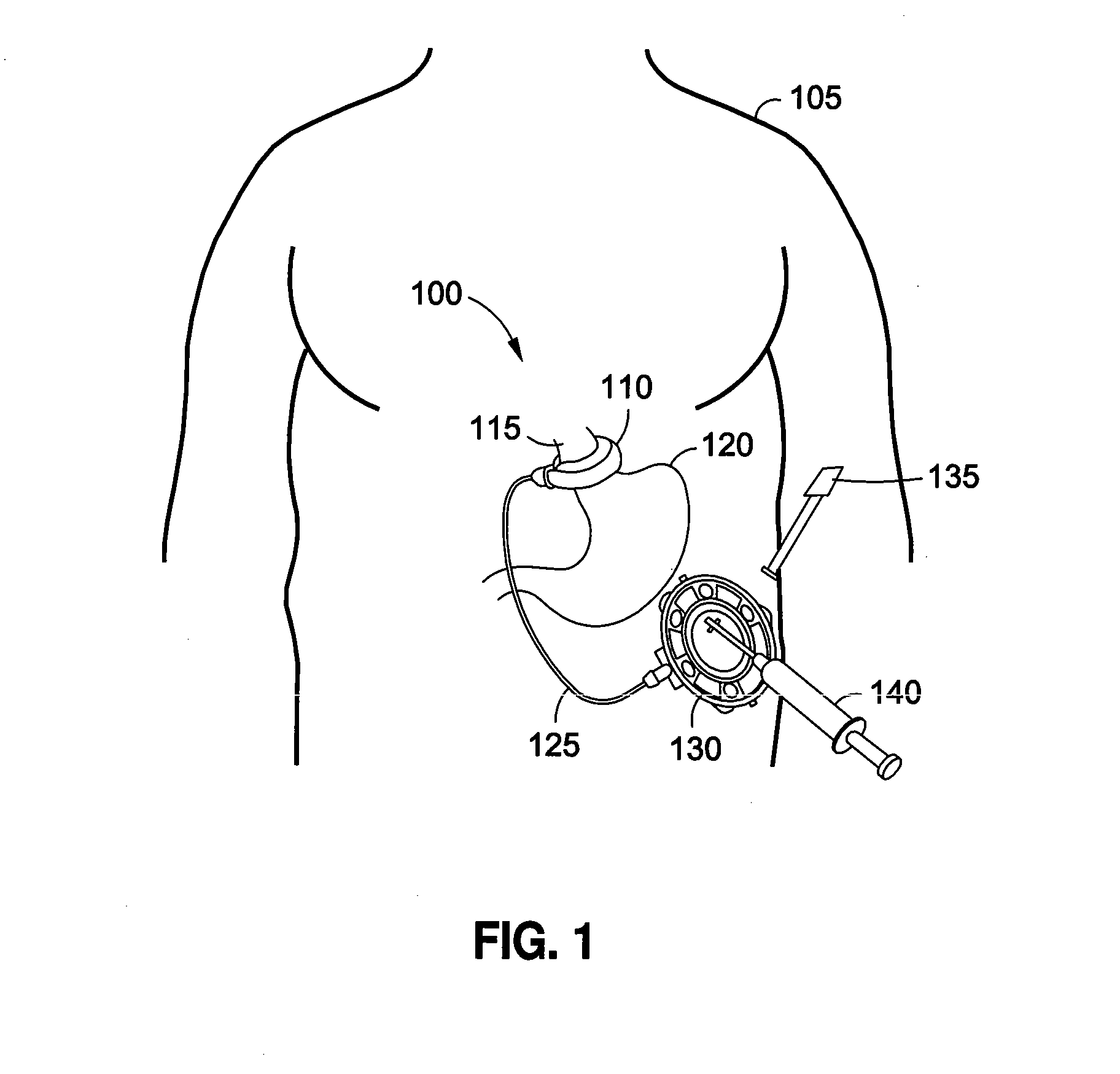 Implantable access port system