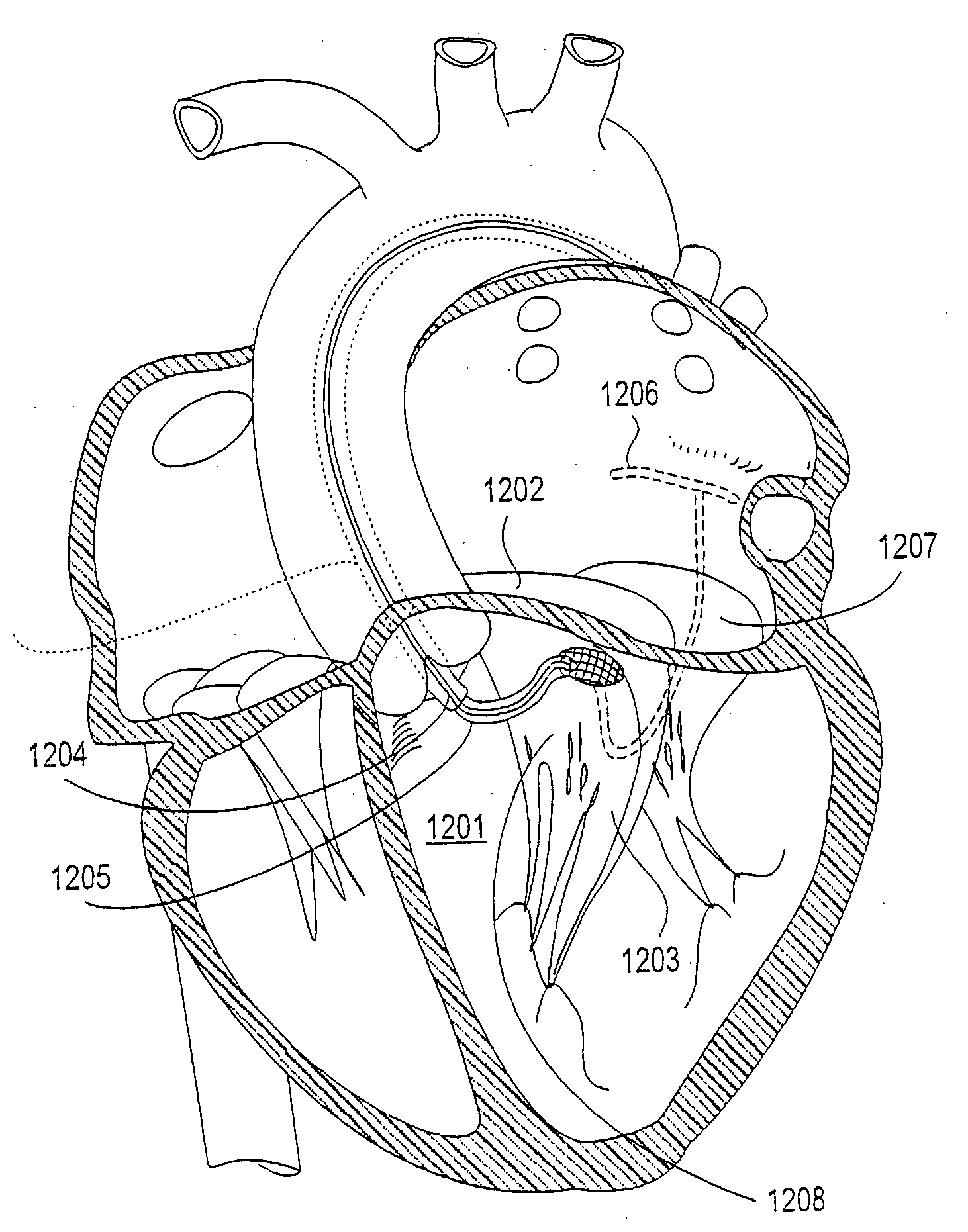 Atrioventricular valve annulus repair systems and methods including retro-chordal anchors