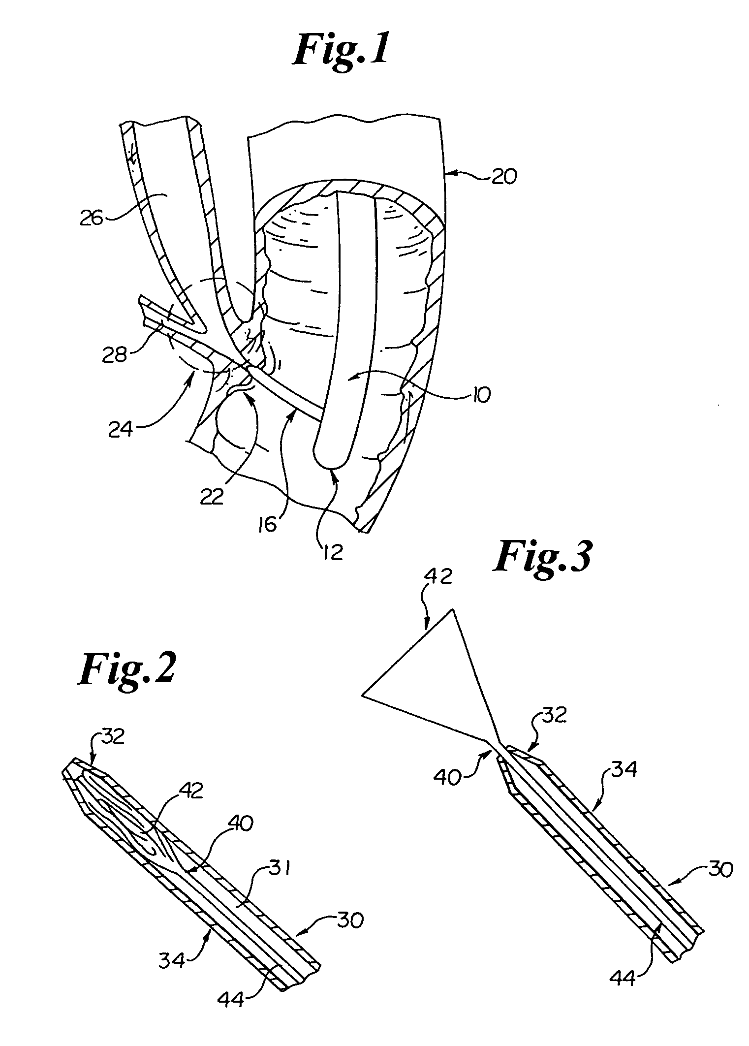 Cone tip biliary catheter and method of use