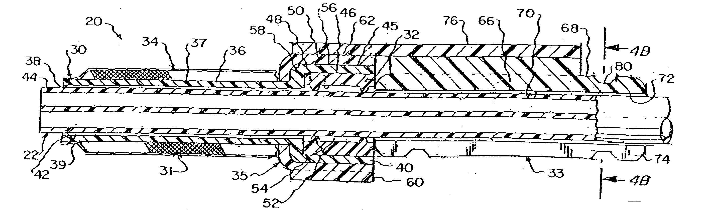 Apparatus and method for percutaneous catheter implantation and replacement