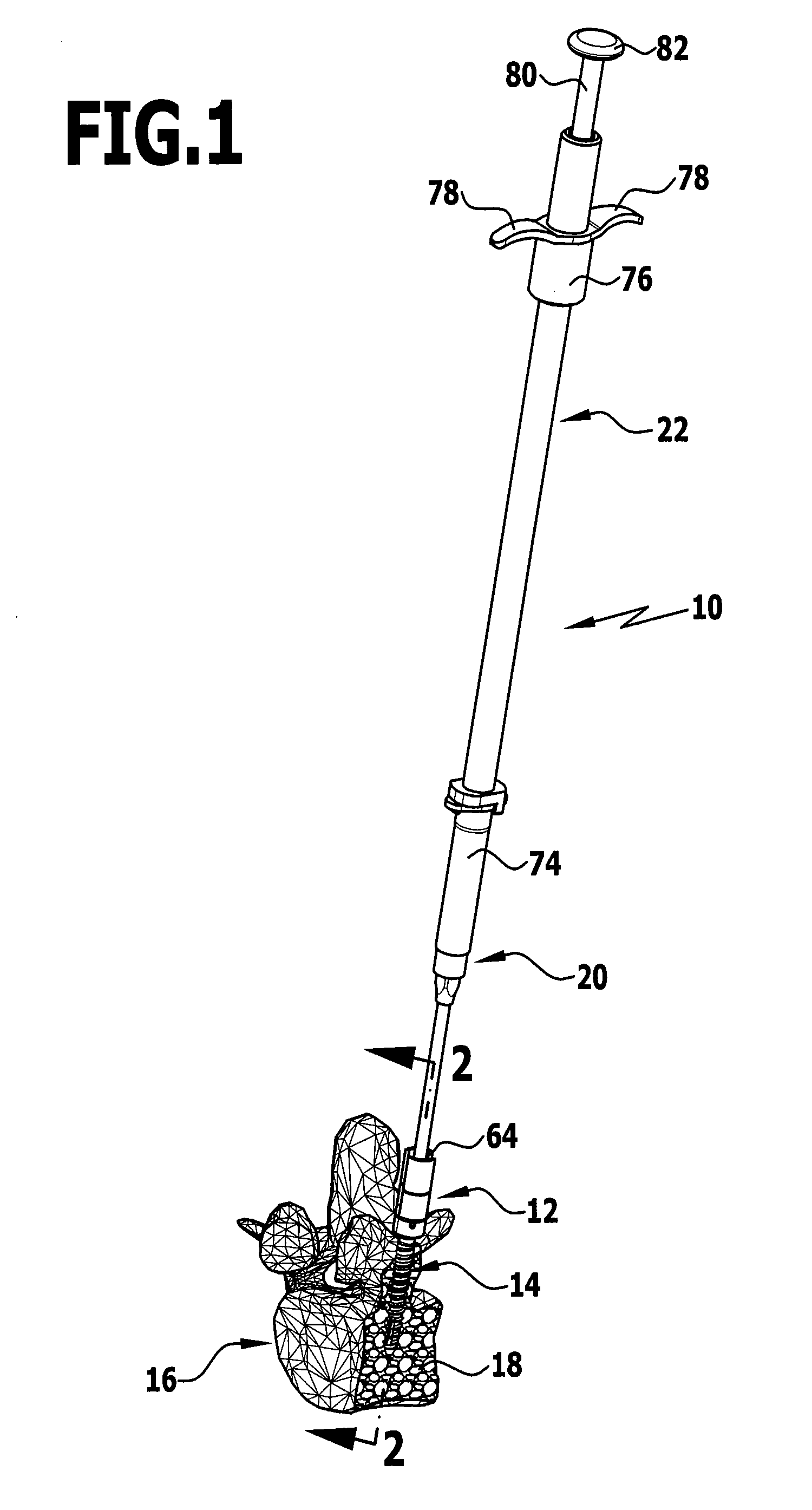 Implant and implantation system