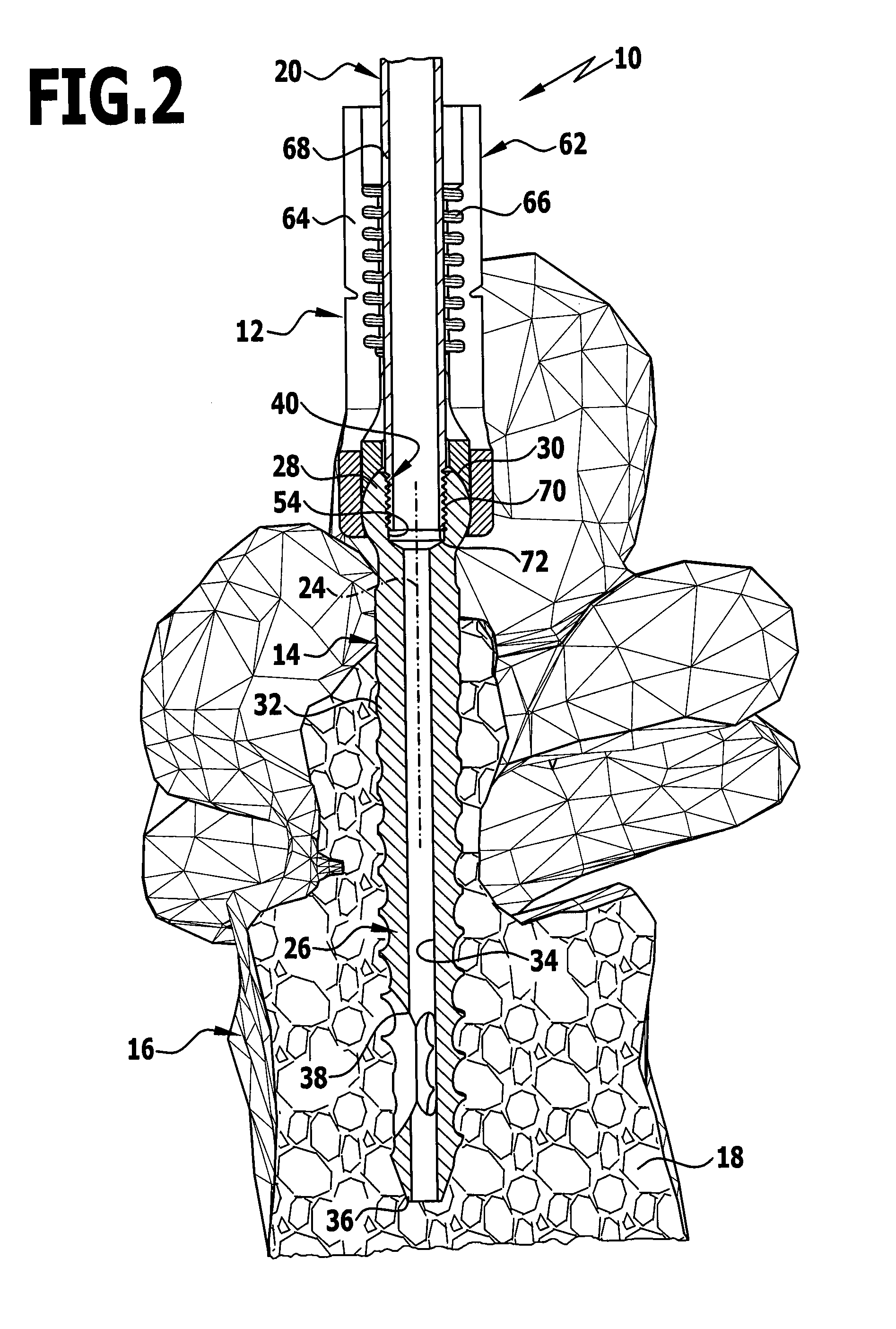 Implant and implantation system